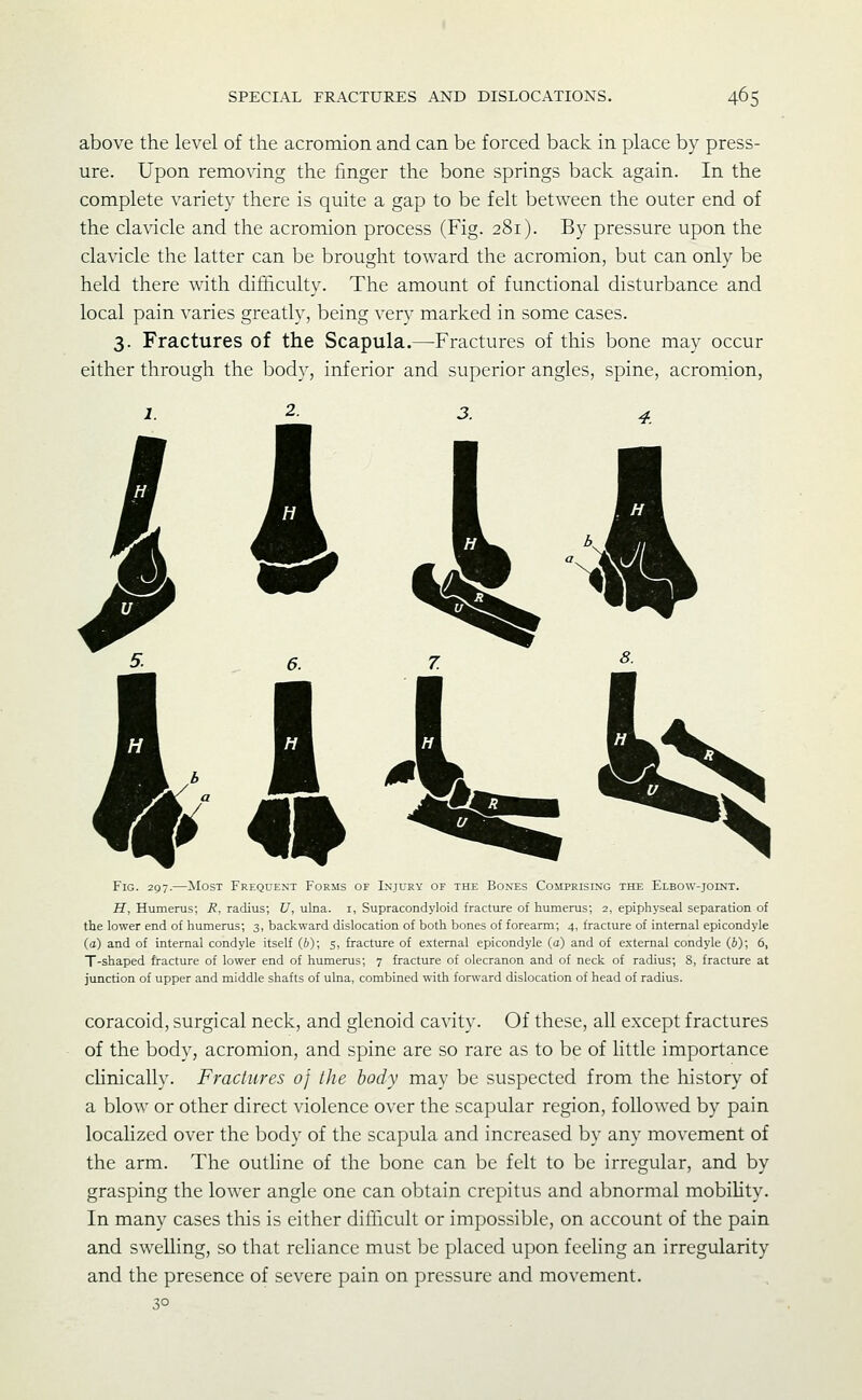 above the level of the acromion and can be forced back in place by press- ure. Upon removing the finger the bone springs back again. In the complete variety there is quite a gap to be felt between the outer end of the clavicle and the acromion process (Fig. 281). By pressure upon the clavicle the latter can be brought toward the acromion, but can only be held there with difficulty. The amount of functional disturbance and local pain varies greatly, being very marked in some cases. 3. Fractures of the Scapula.—Fractures of this bone may occur either through the body, inferior and superior angles, spine, acromion, 2. ill -9* Fig. 297.—Most Frequent Forms of Injury of the Bones Comprising the Elbow-joint. iJ, Humerus; i?, radius; f, ulna, i, Supracondyloid fracture of humerus; 2, epiphyseal separation of the lower end of humerus; 3, backward dislocation of both bones of forearm; 4, fracture of internal epicondyle (a) and of internal condyle itself (i); 5, fracture of external epicondyle (a) and of external condyle (6); 6, T-shaped fracture of lower end of humerus; 7 fracture of olecranon and of neck of radius; 8, fracttire at jimction of upper and middle shafts of ulna, combined with forward dislocation of head of radius. coracoid, surgical neck, and glenoid cavity. Of these, all except fractures of the body, acromion, and spine are so rare as to be of little importance clinically. Fractures of the body may be suspected from the history of a blow or other direct violence over the scapular region, followed by pain localized over the body of the scapula and increased by any movement of the arm. The outline of the bone can be felt to be irregular, and by grasping the lower angle one can obtain crepitus and abnormal mobility. In many cases this is either difficult or impossible, on account of the pain and swelling, so that reliance must be placed upon feeling an irregularity and the presence of severe pain on pressure and movement.