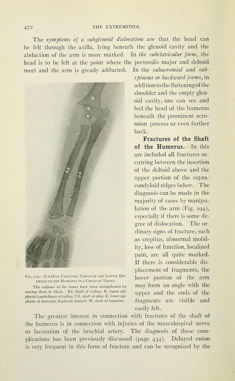 The symptoms of a subglenoid dislocation are that the head can be felt through the axilla, lying beneath the glenoid cavity and the abduction of the arm is more marked. In the subclavicular form, the head is to be felt at the point where the pectorahs major and deltoid meet and the arm is greatly adducted. In the subacromial and sub- spinous or backward forms, in addition to the flattening of the shoulder and the empty glen- oid cavity, one can see and feel the head of the humerus beneath the prominent acro- mion process or even further back. Fractures of the Shaft of the Humerus.—In this are included all fractures oc- curring between the insertion of the deltoid above and the upper portion of the supra- condyloid ridges below. The diagnosis can be made in the majority of cases by manipu- lation of the arm (Fig. 294), especially if there is some de- gree of dislocation. The or- dinary signs of fracture, such as crepitus, abnormal mobil- ity, loss of function, locahzed pain, are all quite marked. If there is considerable dis- placement of fragments, the lower portion of the arm may form an angle with the upper and the ends of the fragments are visible and easily felt. The greatest interest in connection with fractures of the shaft of the humerus is in connection with injuries of the musculospiral nerve or laceration of the brachial artery. The diagnosis of these com- plications has been previously discussed (page 434). Delayed union is very frequent in this form of fracture and can be recognized by the Fig. 304.—X-RAV of Fracture Through the Lower Epi- physis OF THE Humerus in a Child of Three. The outlines of the bones have been strengthened by tracing them in black. RS, Shaft of radius; R, upper epi- physis (capitellum) of radius; US, shaft of ulna; E, lower epi- physis of humerus displaced inward; H, shaft of humerus.