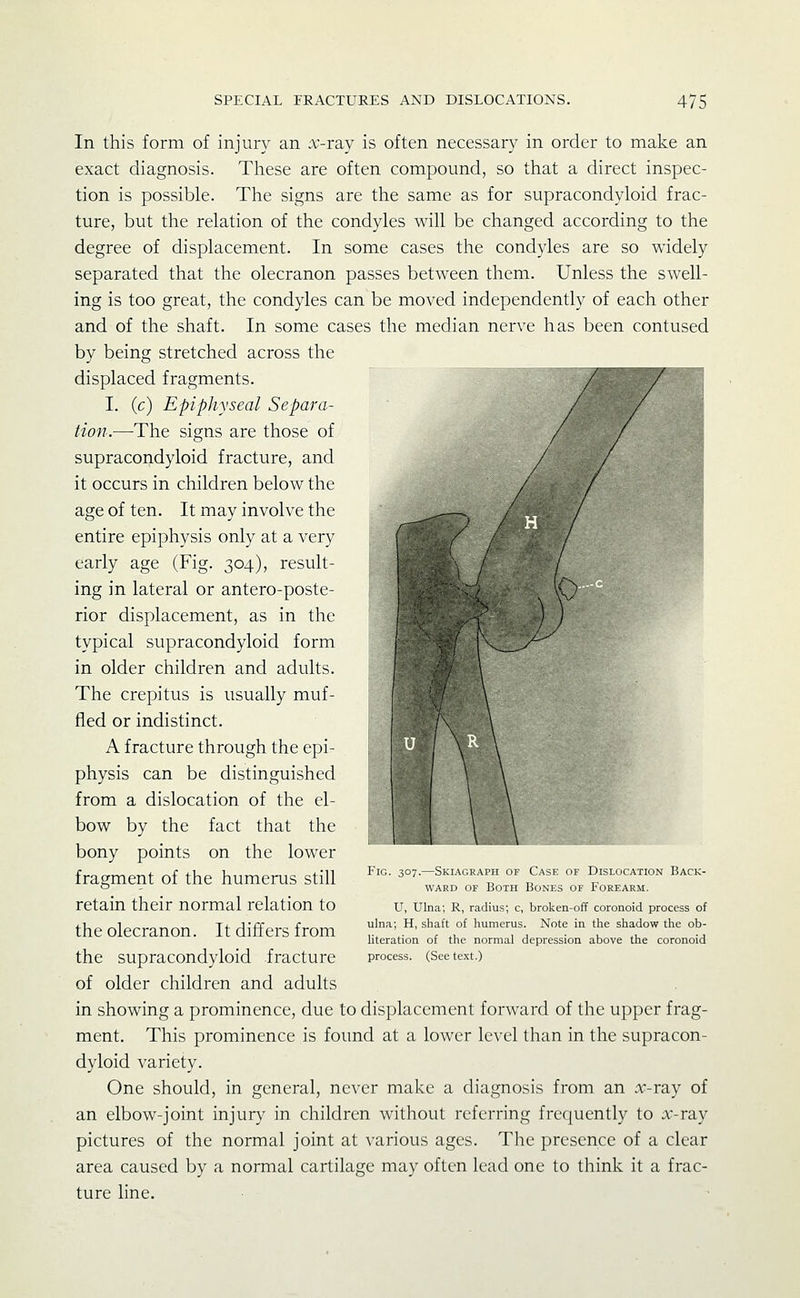 In this form of injury an a'-ray is often necessary in order to make an exact diagnosis. These are often compound, so that a direct inspec- tion is possible. The signs are the same as for supracondyloid frac- ture, but the relation of the condyles will be changed according to the degree of displacement. In some cases the condyles are so widely separated that the olecranon passes between them. Unless the swell- ing is too great, the condyles can be moved independently of each other and of the shaft. In some cases the median nerve has been contused by being stretched across the displaced fragments. I. (c) Epiphyseal Separa- tion.—-The signs are those of supracondyloid fracture, and it occurs in children below the age of ten. It may involve the entire epiphysis only at a very early age (Fig. 304), result- ing in lateral or antero-poste- rior displacement, as in the typical supracondyloid form in older children and adults. The crepitus is usually muf- fled or indistinct. A fracture through the epi- physis can be distinguished from a dislocation of the el- bow by the fact that the bony points on the lower fragment of the humerus still retain their normal relation to the olecranon. It differs from the supracondyloid fracture of older children and adults in showing a prominence, due to displacement forward of the upper frag- ment. This prominence is found at a lower level than in the supracon- dyloid variety. One should, in general, never make a diagnosis from an A'-ray of an elbow-joint injury in children without referring frequently to A'-ray pictures of the normal joint at \'arious ages. The presence of a clear area caused by a normal cartilage may often lead one to think it a frac- ture line. I'lo. J07.—Skial.kaph ui' Case oi Dislocation Back- ward OF Both Bones of Forearm. U, Ulna; R, radius; c, broken-off coronoid process of ulna; H, shaft of humerus. Note in the shadow the ob- literation of the normal depression above the coronoid process. (See text.)