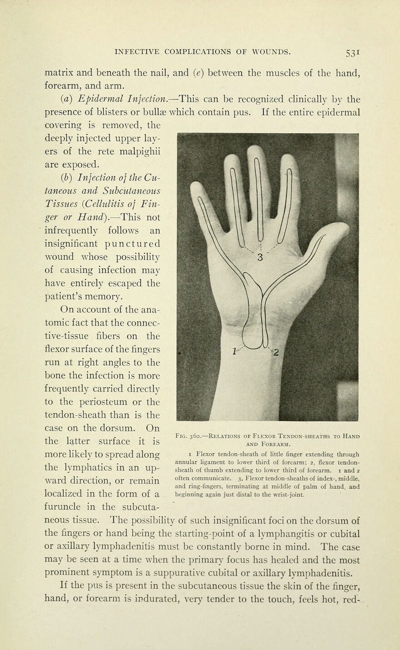 matrix and beneath the nail, and (e) between the muscles of the hand, forearm, and arm. (a) Epidermal Infection.—This can be recognized chnically by the presence of blisters or bullae which contain pus. If the entire epidermal covering is removed, the deeply injected upper lay- ers of the rete malpighii are exposed. (b) Infection of the Cu- taneous and Subcutaneous Tissues {Cellulitis of Fin- ger or Hand).—This not infrequently follows an insignificant punctured wound whose possibihty of causing infection may have entirely escaped the patient's memory. On account of the ana- tomic fact that the connec- tive-tissue fibers on the flexor surface of the fingers run at right angles to the bone the infection is more frequently carried directly to the periosteum or the tendon-sheath than is the case on the dorsum. On the latter surface it is more likely to spread along the lymphatics in an up- ward direction, or remain localized in the form of a furuncle in the subcuta- neous tissue. The possibility of such insignificant foci on the dorsum of the fingers or hand being the starting-point of a lymphangitis or cubital or axillary lymphadenitis must be constantly borne in mind. The case may be seen at a time when the primary focus has healed and the most prominent symptom is a suppurative cubital or axillary lymphadenitis. If the pus is present in the subcutaneous tissue the skin of the finger, hand, or forearm is indurated, very tender to the touch, feels hot, red- FiG. 360.—Relations of Flexor Tendon-sheaths to Hand AND Forearm. I Flexor tendon-sheath of little finger extending through annular Ugament to lower third of forearm; 2, flexor tendon- sheath of thumb extending to lower third of forearm, i and 2 often communicate. 3, Flexor tendon-sheaths of index-, middle, and ring-fingers, terminating at middle of palm of hand, and beginning again just distal to the wrist-joint.