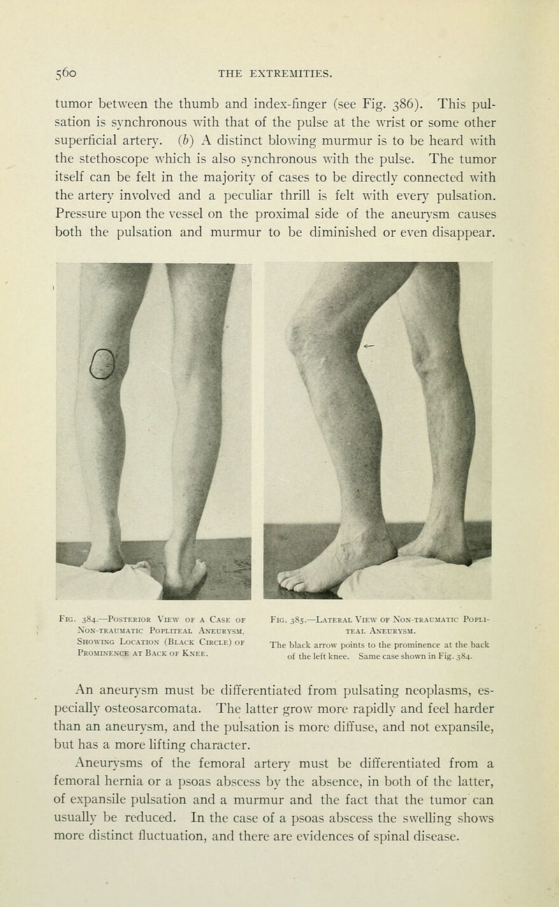 tumor between the thumb and index-iinger (see Fig. 386). This pul- sation is synchronous with that of the pulse at the wrist or some other superficial artery, (b) A distinct blowing murmur is to be heard with the stethoscope which is also synchronous with the pulse. The tumor itself can be felt in the majority of cases to be directly connected with the arter}^ involved and a peculiar thrill is felt with every pulsation. Pressure upon the vessel on the proximal side of the aneurysm causes both the pulsation and murmur to be diminished or even disappear. Fig. 384.—Posterior View of a Case of Non-traumatic Popliteal Aneurysm, Showing Location (Black Circle) of Prominence at Back of Knee. Fig. 385.—Lateral View of Non-traumatic Popli- teal Aneurysm. The black arrow points to the prominence at the back of the left knee. Same case shown in Fig. 384. An aneurysm must be differentiated from pulsating neoplasms, es- pecially osteosarcomata. The latter grow more rapidly and feel harder than an aneurysm, and the pulsation is more diffuse, and not expansile, but has a more lifting character. Aneurysms of the femoral arter}^ must be differentiated from a femoral hernia or a psoas abscess by the absence, in both of the latter, of expansile pulsation and a murmur and the fact that the tumor can usually be reduced. In the case of a psoas abscess the swelling shows more distinct fluctuation, and there are evidences of spinal disease.