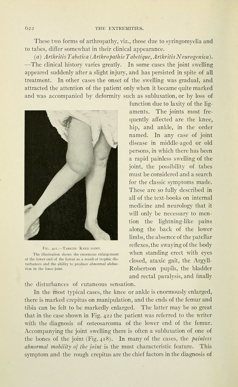 These two forms of arthropathy, viz., those due to syringomyeha and to tabes, differ somewhat in their dinical appearance. (a) Arthritis Tabetica (Arthropathie Tabetique, ArthritisNeurogenica). —The cKnical history varies greatly. In some cases the joint swelling appeared suddenly after a shght injury, and has persisted in spite of all treatment. In other cases the onset of the swelling was gradual, and attracted the attention of the patient only when it became quite marked and was accompanied by deformity such as subluxation, or by loss of function due to laxity of the Hg- aments. The joints most fre- quently affected are the knee, hip, and ankle, in the order named. In any case of joint disease in middle-aged or old persons, in which there has been a rapid painless swelling of the joint, the possibihty of tabes must be considered and a search for the classic symptoms made. These are so fully described in all of the text-books on internal medicine and neurology that it will only be necessary to men- tion the lightning-like pains along the back of the lower limbs, the absence of the patellar reflexes, the swaying of the body when standing erect with eyes closed, ataxic gait, the Argyll- Robertson pupils, the bladder and rectal paralysis, and finally the disturbances of cutaneous sensation. In the most typical cases, the knee or ankle is enormously enlarged, there is marked crepitus on manipulation, and the ends of the femur and tibia can be felt to be markedly enlarged. The latter may be so great that in the case shown in Fig. 422 the patient was referred to the writer with the diagnosis of osteosarcoma of the lower end of the femur. Accompanying the joint sweUing there is often a subluxation of one of the bones of the joint (Fig. 418). In many of the cases, the painless abnormal mobility of the joint is the most characteristic feature. This symptom and the rough crepitus are the chief factors in the diagnosis of Fig. 421.—Tabetic Knee-joint. The illustration shows the enormous enlargement of the lower end of the femur as a result of trophic dis- turbances and the abiUty to produce abnormal abduc- tion in the knee-joint.