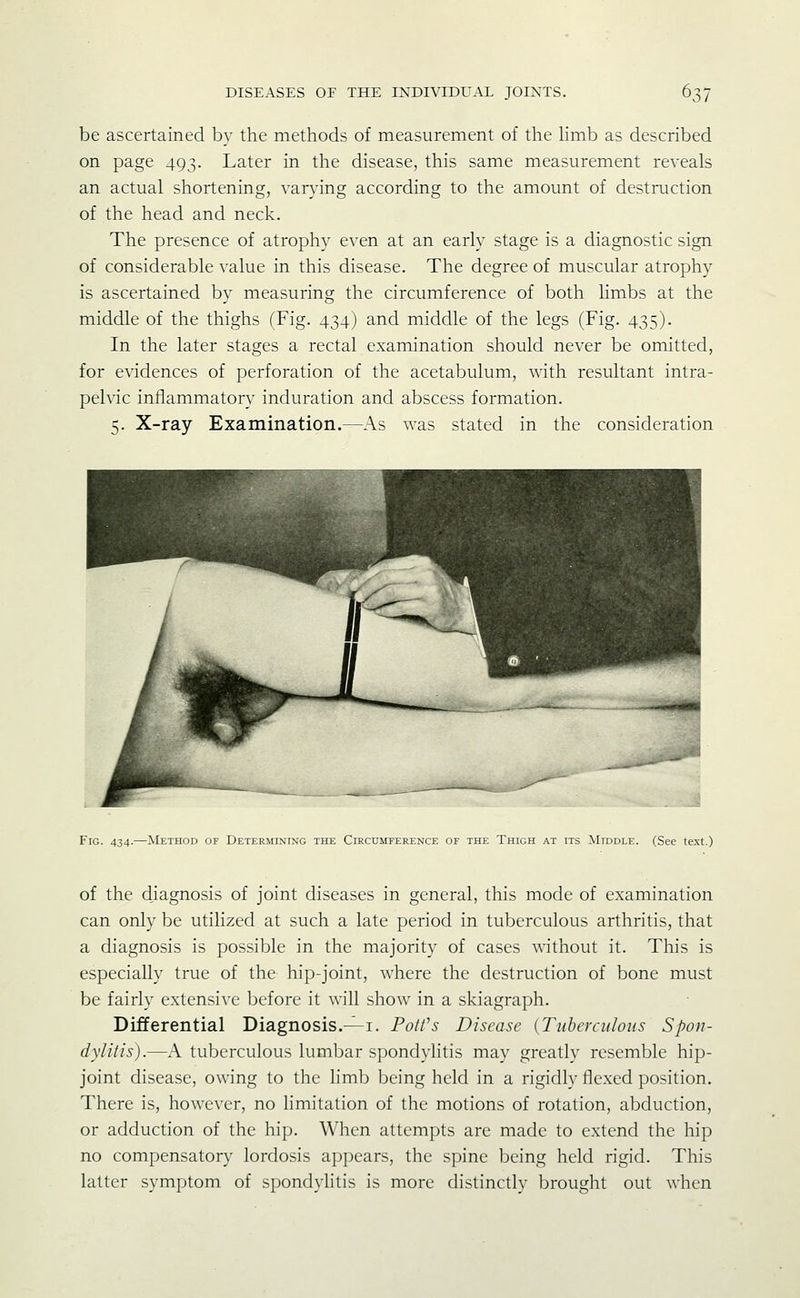 be ascertained by the methods of measurement of the hmb as described on page 493. Later in the disease, this same measurement reveals an actual shortening, var}'ing according to the amount of destruction of the head and neck. The presence of atrophy even at an early stage is a diagnostic sign of considerable value in this disease. The degree of muscular atrophy is ascertained by measuring the circumference of both hmbs at the middle of the thighs (Fig. 434) and middle of the legs (Fig. 435). In the later stages a rectal examination should never be omitted, for evidences of perforation of the acetabulum, with resultant intra- pelvic inflammatory induration and abscess formation. 5. X-ray Examination.—As was stated in the consideration Fig. 434.—Method of Determining the Circumference of the Thigh at its Middle. (See te.xt.) of the diagnosis of joint diseases in general, this mode of examination can only be utilized at such a late period in tuberculous arthritis, that a diagnosis is possible in the majority of cases without it. This is especially true of the hip-joint, where the destruction of bone must be fairly extensive before it will show in a skiagraph. DiJfferential Diagnosis.-^i. PoWs Disease {Tuberculous Spon- dylitis).—A tuberculous lumbar spondylitis may greatly resemble hip- joint disease, owing to the hmb being held in a rigidly flexed position. There is, however, no limitation of the motions of rotation, abduction, or adduction of the hip. When attempts are made to extend the hip no compensatory lordosis appears, the spine being held rigid. This latter symptom of spondyhtis is more distinctly brought out when