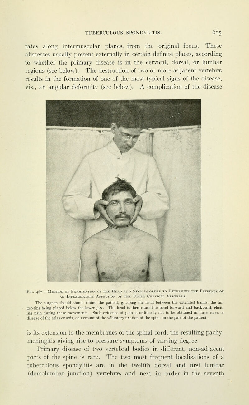 tates along intermuscular planes, from the original focus. These abscesses usually present externally in certain definite places, according to whether the primary disease is in the cervical, dorsal, or lumbar regions (see below). The destruction of two or more adjacent vertebrae results in the formation of one of the most typical signs of the disease, viz., an angular deformity (see below). A comphcation of the disease Fig. 467.—Method of Examination of the Head and Neck in order to Determine the Presence of AN Inflammatory Affection of the Upper Cervical Vertebra. The surgeon should stand behind the patient, grasping the head between the extended hands, the fin- ger-tips being placed below the lower jaw. The head is then caused to bend forward and backward, elicit- ing pain during these movements. Such evidence of pain is ordinarily not to be obtained in these cases of disease of the atlas or axis, on account of the voluntary fixation of the spine on the part of the patient. is its extension to the membranes of the spinal cord, the resulting pachy- meningitis giving rise to pressure symptoms of varying degree. Primary disease of two verteljral bodies in different, non-adjacent parts of the spine is rare. The two most frequent locahzations of a tuberculous spondylitis are in the twelfth dorsal and first lumbar (dorsolumbar junction) vertebrae, and next in order in the seventh