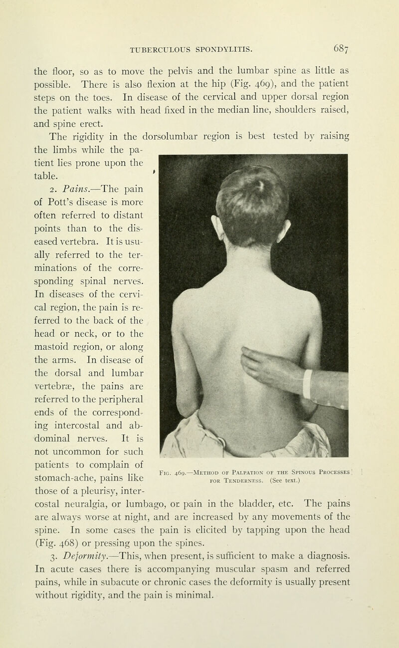 the floor, so as to move the pelvis and the lumbar spine as little as possible. There is also flexion at the hip (Fig. 469), and the patient steps on the toes. In disease of the cervical and upper dorsal region the patient walks with head fixed in the median Hne, shoulders raised, and spine erect. The rigidity in the dorsolumbar region is best tested by raising the Hmbs while the pa- tient lies prone upon the table. 2. Pains.—The pain of Pott's disease is more often referred to distant points than to the dis- eased vertebra. It is usu- ally referred to the ter- minations of the corre- sponding spinal nerves. In diseases of the cervi- cal region, the pain is re- ferred to the back of the head or neck, or to the mastoid region, or along the arms. In disease of the dorsal and lumbar vertebrae, the pains are referred to the peripheral ends of the correspond- ing intercostal and ab- dominal nerves. It is not uncommon for such patients to complain of stomach-ache, pains like those of a pleurisy, inter- costal neuralgia, or lumbago, or pain in the bladder, etc. The pains are always worse at night, and arc increased by any movements of the spine. In some cases the pain is elicited by tapping upon the head (Fig. 468) or pressing upon the spines. 3. Dejormity.—This, when present, is sufficient to make a diagnosis. In acute cases there is accompanying muscular spasm and referred pains, while in subacute or chronic cases the deformity is usually present without rigidity, and the pain is minimal. Fig. 469. Method of Palpation of the Spinous Processes ' FOR Tenderness. (See text.)