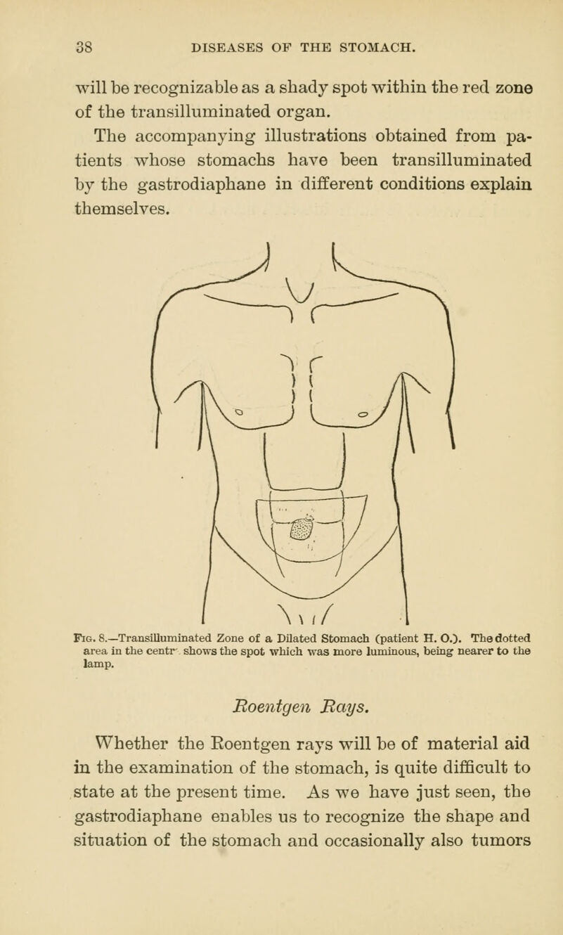 will be recognizable as a shady spot within the red zone of the transilluminated organ. The accompanying illustrations obtained from pa- tients whose stomachs have been transilluminated by the gastrodiaphane in different conditions explain themselves. Fig. 8.—Transilluminated Zone of a Dilated Stomach (patient H. O.). The dotted area in the centr shows the spot which was more luminous, being nearer to the lamp. Roentgen Rays. Whether the Eoentgen rays will be of material aid in the examination of the stomach, is quite difficult to state at the jDresent time. As we have just seen, the gastrodiaphane enables us to recognize the shape and situation of the stomach and occasionally also tumors