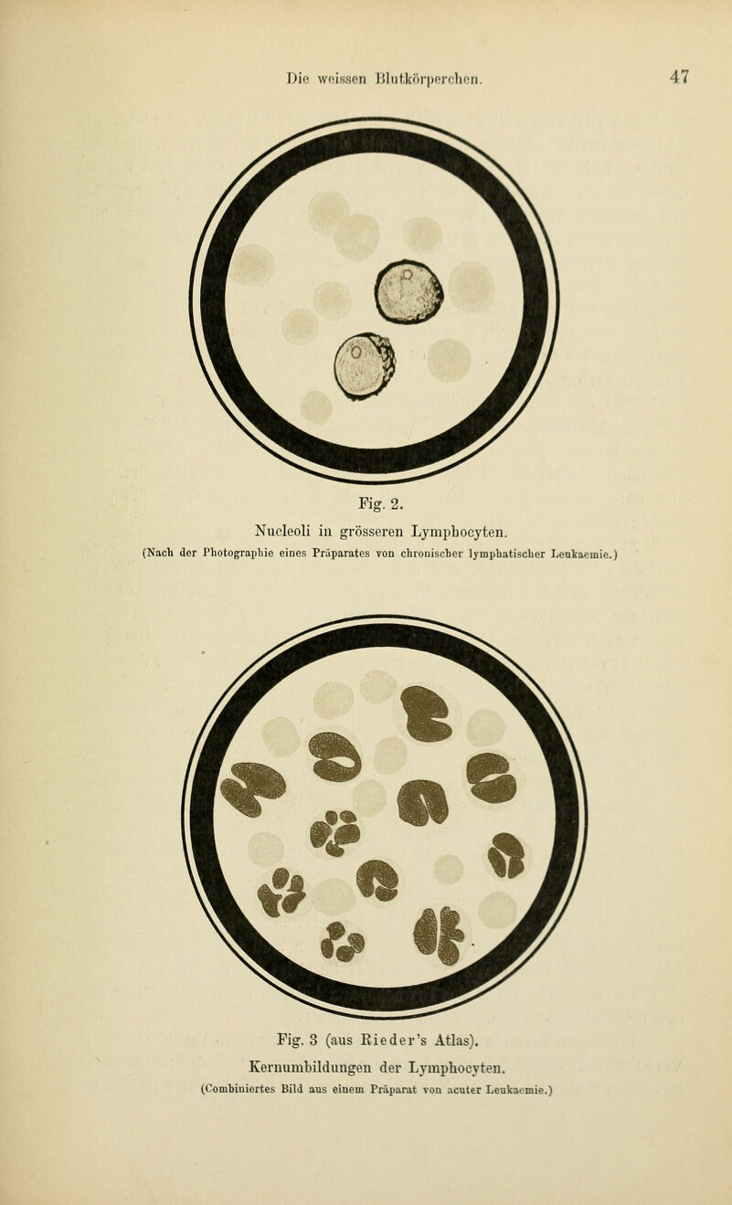 Fig. 2. Nucleoli in grösseren Lymphocyten. (Nach der Photographie eines Präparates von chronischer lymphatischer Lenkaeinie.) Fig. 3 (aus Ried er's Atlas). Keruumbildungen der Lympkocyten. (Cornhiniertes Bild aus einem Präparat von acuter Leukaemie.)