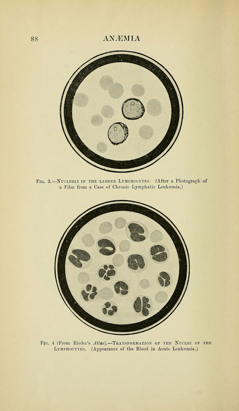 ANtEMTA Fig. 3.—Nucleoli in the larger Lymphocytes. (After a Photograph of a Film from a Case of Chronic Lymphatic Leukaemia.) Fig. 4 (From Eieder's Atlas),—Transformation of the Nuclei of the Lymphocytes. (Appearance of the Blood in Acute Leukaemia.)