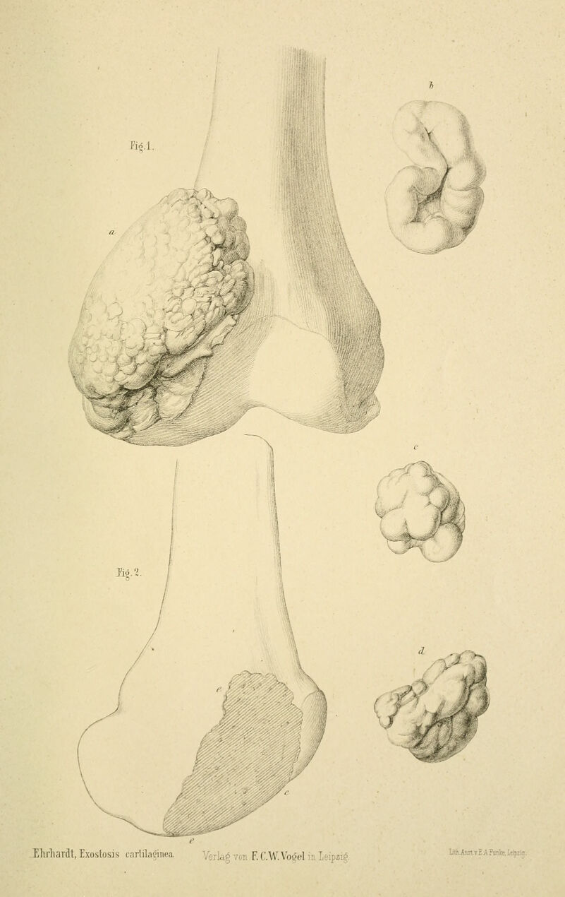 Fid.l. ,^ Ehrlianlt, Exoslosis carlila'iinca. ^kAä.% von F. C.W.Vo^el in Leipzig litUiislrEAitalce.UiF::'^