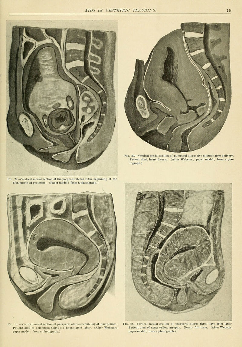 Fig. 30.—Vertical mesial seclion of piKn-ueral iiterii8 live niiuutes after delivery. Patient died, heart disease. (After Webster ; paper model; from a pho- tograph.) Fig. 29.—Vertical mesial section of the pregnant uterus at the beginning of the fifth month of gestation. (Paper model; from a photograph.) Kio, yj.—Vertical menial Hc-ction of puerperal uterus ECConOuay of pueiperium. Fia. 32.—Vertical mcBial section of puerperal uterus three days after labor^ Patient died of eclampsia thirty-six hours after labor, (After Webster; Patient died of acute yellow atrophy. Nearly full term. (After Webster; paper model; from a photograph.) paper model; from a photograph.)