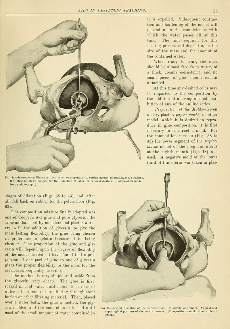 it is expelled. Subsequent contrac- tion and hardening of the model will depend upon the completeness with which the water passes off at this time. The time ■ required for this heating process will depend upon the size of the mass and the amount of the contained water. When ready to pour, the mass should be almost free from water, of a thick, creamy consistence, and no small pieces of glue should remain unmelted. At this time any desired color may be imparted to the composition by the addition of a strong alcoholic so- lution of any of the aniline series. Preparation of the Mold.—Given a clay, plaster, papier-mache, or other model, which it is desired to repro- duce in glue composition, it is first necessary to construct a mold. For the composition cervices (Kgs. 38 to 43) the lower segment of the papier- mache model of the pregnant uterus at the eighth month (Fig. 18) was used. A negative mold of the lower third of this uterus was taken in plas- FiG. 44.—Instrumental dilatation or i the introduction of bougies tor from a photograph.) aii'iil o.~ preparatory]to further manual dilatation, i^auze packing, iudmjtiou of labor, or cervical dilators. (Composition model; stages of dilatation (Figs. 38 to 43), and, after all, fall back on rubber for the pelvic floor (Fig. 63). The composition mixture finally adopted was one of Cooper's A-1 glue and pure glycerin, the same as that used by modelers and plaster work- ers, with the addition of glycerin, to give the mass lasting flexibility, the glue being chosen in preference to gelatin because of its being cheaper. The proportion of the glue and gly- cerin will depend upon the degree of flexibility of the model desired. I have found that a pro- portion of one part of glue to one of glycerin gives the proper flexibility to the mass for the cervices subsequently described. The method is very simple and, aside from the glycerin, very cheap. The glue is first soaked in cold water until moist; the excess of water is then removed by filtering through stout burlap or other filtering material. Then, placed over a water bath, the glue is melted, the gly- cerin added, and the mass allowed to boil until most of the small amount of water contained in Fio. 4.').—Digital dilatation of the parturient 08. supravaginal portions of the cervix present, graph.) Os admits one linger. (Composition model; Vaginal and from a photo-