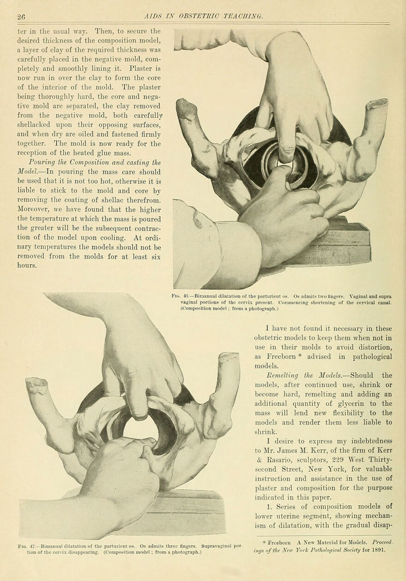 tor in the usual way. Then, to secure the desired thickness of the composition model, a la3'er of clay of the required thickness was carefully placed in the negative mold, com- pletely and smoothly lining it. Plaster is now run in over the clay to form the core of the interior of the mold. The plaster heing thoroughly hard, the core and nega- tive mold are separated, the clay removed from the negative mold, both carefully shellacked upon their opposing surfaces, and when dry are oiled and fastened firmly together. The mold is now ready for the reception of the heated glue mass. Pouring the Composition and casting the Model.—In pouring the mass care should be used that it is not too hot, otherwise it is liable to stick to the mold and core by removing the coating of shellac therefrom. Moreover, we have found that the higher the temperature at which the mass is poured the greater will be the subsequent contrac- tion of the model upon cooling. At ordi- nary temperatures the models should not be removed from the molds for at least six hours. Fig. 45.—Bimanual dilatation of the parturient OS. Os admits two fingers. Vaginal and supra vaginal portions of the cervix present. Commencing shortening of the cervical canal. (Composition model ; from a photograph.) I have not found it necessary in these obstetric models to keep them when not in use in their molds to avoid distortion, as Freeborn * advised in pathological models. Eemelting the Models.—Should the models, after continued use, shrink or become hard, remelting and adding an additional quantity of glycerin to the mass will lend new flexibility to the models and render them less liable to shrink. I desire to express my indebtedness to Mr. James M. Kerr, of the firm of Kerr & Easario, sculptors, 229 West Thirty- second Street, New York, for valuable instruction and assistance in the use of plaster and composition for the purpose indicated in this paper. 1. Series of composition models of lower uterine segment, showing mechan- ism of dilatation, with the gradual disap- FiG. 47.—Bimanual dilatation of the parturient OS. Os admits three fingers. Suprt tion Of the cervix disappearing. (Composition model; from a photograph.) * Freeborn A New Material for Models. Proceed. higs of the New York Pathological Society for 1891.