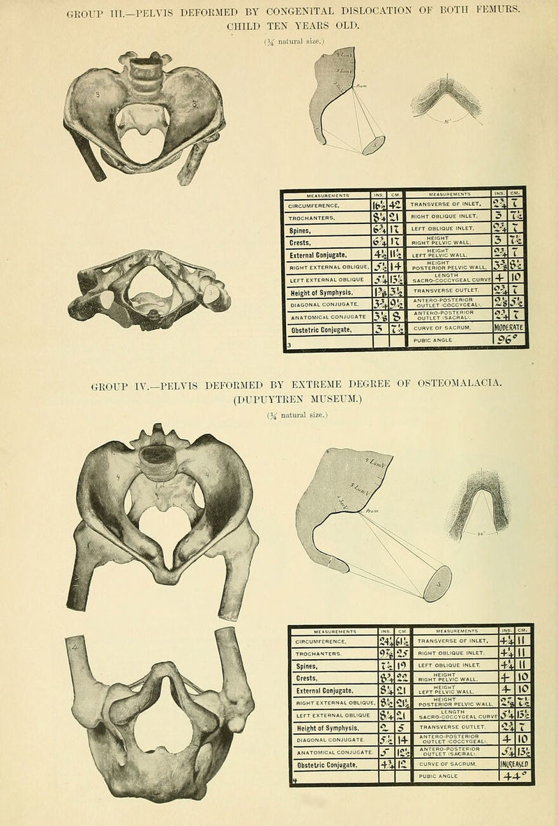 GROUP Til.—I'ELVIS DEFORMED BY CONGENITAL DISLOCATION OF BOTH FEMURS. CHILD TEN YEARS OLD. I}{ naluval size.) ^ ^T T!?  CIRCUMFERENCE, lt.5r 4-Z -■4 I TROCHflNTEHS, ^'4 t\ RIGHT OBLIQUE INLET, c ic Spines, 6% 11 LEFT OBLIQUE INLET, c-v <. . Crests, 6> n right'p'e\vIc wall. 5 T'c External Conjugate, 4.I1 He ^j,^IJ|[=7j^,5LL, <u I RIGHT EXTERNAL OBUOUE. •?'I: 14 posteriSS''pelvic wall. P t^c LEFT EXTERNAL OBLIQUE s* 15!' SACRO-COCCYGEAL CURVE 4- 10 Height Of Symphysis. l?ii 3'-, TRANSVERSE OUTLET. 0^ c DIAGONAL CONJUGATE, 3^-t P'.2 ^Z's ,?« ANATOMICAL CONJUGATE 5'« s *SJ^['^t™aJral° 2-4IT 1 Obstetric Conjugate, 3 ' ■; CURVE OF SACRUM, MOPERATeI 3 ^, PUBIC ANGLE ?6^ 1 GROUP IV.—PELVIS DEFORMED BY EXTREME DEGREE OF OSTEOMALACIA. (DUPUYTBEN MUSEUM.) (}£ natural size.)  ^T  fur C.PCUMFERENCE, 24; ti:.. TRANSVERSE OF INLET. 4* II TROCHANTERS. 'f 41^ RIGHT OBLIQUE INLET, 4+ II Spines, t'c I'' LEFT OBLIQUE INLET 4+ II Crests, &t fli' RIGHT PE°Lvlc WALL, f 10 External Conjugate. sv •II ^^„'il'S',Iv,„LL. 4- 10 RIGHT EXTERNAL OBLIQUE, &'• -''t POSTERIOR PELVIC WALL, ~i te LEFT EXTERNAL OBLIQUE sv ii SACRO-COCCYGEAL CURVE S'^ 15!: Height Of Symphysis, r> ;> TRANSVERSE OUTLET. 'ii 7 DIAGONAL CONJUGATE 5i 14 Sutle°t'^?Icg°eal.. 4- 10 ANATOMIC.L CONJUGATE j l£'- SiT^Ei'Mll^l'L, J+ 15^ Obstetric Conjugate, +'+ I'l CURVE OF SACRUM. INKEAStD 1 ^,^ 4^4-!