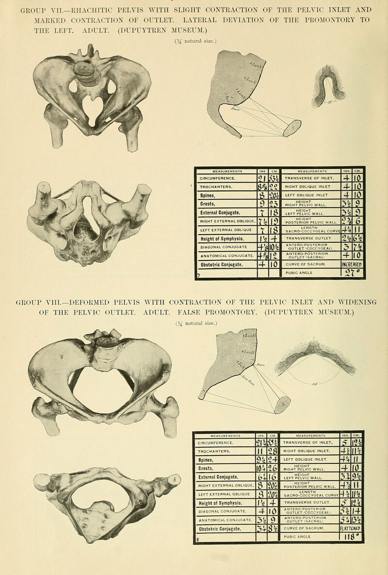 GROUP VII.—RIIACIilTIC PELVIS WITH SLIGHT CONTRACTION OF THE PELVIC INLET AND MARKED CONTRACTION OF OUTLET. LATERAL DEVIATION OF THE PROMONTORY TO THE LEFT. ADULT. (DUPUYTREN MUSEUM.) (3^ natural i T? TT   CIRCUMFERENCE. V ^yn TRANSVERSE OF INLET. 4 10 TROCHANTERS, n oo RIGHT OBLIQUE INLET 4- 10 Spines, ?> 'iOk LEFT OBLIQUE INLET 4 10 Crests, e 1? RIGHT PeIvIc wall. I'ii ? External Conjugate. T 18 LEFT pfl.v'i'J WALL, j'i ^ RIGHT EXTERNAL OBLIOUE, l^ 1? post?r'iSS^pelvic wall. n 6 LEFT EXTERNAL OBLIQUE li^ SACBO-COCCYGEAL CURVE -/-if II Height of Symphysis. I's ■i TRANSVERSE OUTLET 2'. 6'a DIAGONAL CONJUGATE. ■+y \0k j> n ANATOMICAL CONJUGATE. n \t ''SiTL°T'':tll«S'' -f 10 Obstetric Conjugate, -4- 10 CURVE OF SACRUM. mmn 1 7 ^ PUBIC ANGLE 2t| GROUP VIII.—DEFORMED PELVIS WITH CONTRACTION OF THE PELVIC INLET AND WIDENING OF THE PELVIC OUTLET. ADULT. FALSE PROMONTORY. (DUPUYTREN MUSEUM.) {}£ natural size.)   T?  C.RCUMFERENCE. er, SJi TRANSVERSE OF INLET. ;> m TROCHANTERS. II 2{? RIGHT OBLIQUE INLET, 4h \\k Spines, ou 24 LEFT OBLIQUE INLET -f'-f If Crests, lov 26 RIGHT PE°Lvlc WALL. -f (0 External Conjugate. bi 16 LEFT'JimJwALL. ?l ?^ RIGHT EXTERNAL OBLIQUE. 8 20£ postehiSr'pelvic wall. 4'? II 8 20; SACRO-GOCCYGEAL CURVE 4*i \j<i Height Of Symphysis. I'e 4 TRANSVERSE CUTLET. ^ iVi DIAGONAL CONJUGATE. 4 10 ''SJe°t'^?oJcyg°e''al.. 51: 14 ANATOMIC.L CONJUGATE. j'i 9 SjTrE°Tli!JRAU.'' ik (3V Obstetric Conjugate, i>^ S't CURVE OF SACRUM. fiATTENeo 1 «