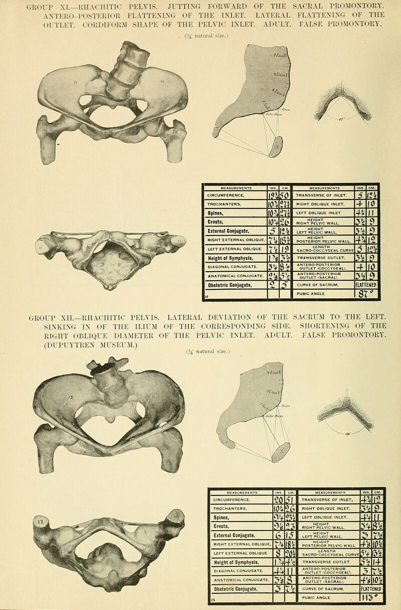 GROUP XL—KHACIIITIC PELVIS. JUTTING FORWARD OF THE SACRAL PROMONTORY. ANTERO-POSTERIOR FLATTENING OF THE INLET. LATERAL FLATTENING OF THE OUTLET. CORDIFORM SHAPE OF THE PELVIC INLET. ADULT. FALSE PROMONTORY. . {}{ natural i     CIBCUMFERENCE, \?\ ^Q TRANSVERSE OF INLET, 5 12'i TROCHANTERS. m m RIGHT OBLIQUE INLET, 4 10 Spines, (O'-f tVi LEFT OBLIQUE INLET 4fi- II Crests, lOV £5 RIGHT p'e°LvIc wall. -?^ 9 External Conjugate, J liH LEFT PELVIC wall, ?'? ? RIGHT EXTERNAL OBLIQUE, TV (^? poster'iSS^pelvic wall. r-* IS LEFT EXTERNAL OBLIQUE T's 19 SACRO.COCCYGE.L CURVE p If? Height of Symphysis, 1'? T *'' TRANSVERSE OUTLET, 5'# 9 DIAGONAL CONJUGATE. 5V 8'f ''S;tle°t';??Jge'ali, 4 10 ANATOMICAL CONJUGATE. 2'!^ p' SutlTt'^sIJr^'S. 5^? f) Obstetric Conjugate, o ? CURVE OF SACRUM, FUTTENEdI .. PUBIC ANGLt SX 1 GROUP XII.—RHACHITIC PELVIS. LATERAL DEVIATION OF THE SACRUM TO THE LEFT. SINKING IN OF THE ILIUM OF THE CORRESPONDING SIDE. SHORTENING OF THE RIGHT OBLIQUE DIAMETER OF THE PELVIC INLET. ADULT. FALSE PROMONTORY. (DUPUYTREN MUSEUM.) {}£ natural  T!r T?  CIRCUMFERENCE. 20 p| TRANSVERSE OF INLET, 4'-f 12 TROCHANTERS. 10!. ^6 RIGHT OBLIQUE INLET, ?'« C) Spines, 9'f ??'•> 4V II Crests, f;- li' RIGHT PE°Lvlc WALL, ^V ?'i External Conjugate, G 15 LEFT plmJ WALL, ^ Vi RIGHT EXTERNAL OBLIQUE. v'V m POST?RlSS^PELV,C WALL, ■f's \n LEFT EXTERNAL OBLIQUE $ ?(i{ SACRO-COCCVGEAL CURVE ?'f m Height Of Symphysis. \h -f'-i TRANSVERSE OUTLET, p'? (4 DIAGONAL CONJUGATE, -fV U ''SuTlZT''°olccAi.\ T Vi ANATOMICAL CONJUGATE, j's ^ ''Si°j'%rc%i'S'' i's lOV Obstetric Conjugate, J} TV CURVE OF SACRUM, fLATTENEO 1 n '15' 1