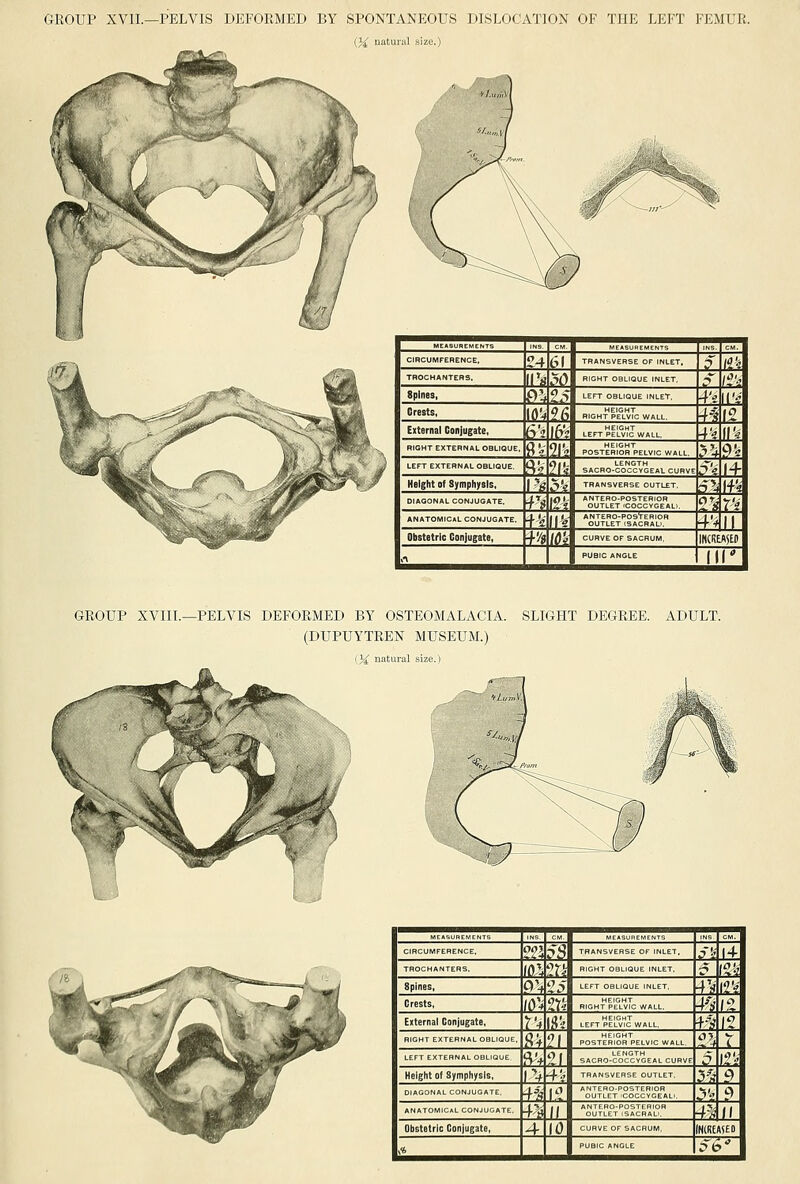 GROUP XVIL—PELVIS DEFORMED BY SPONTANEOUS DISLOCATION OF THE LEFT FEMUR. (3^ natural size.)   T?  CJRCUMFERENCE, ?4 C^i TRANSVERSE OF INLET, p \i\ TROCHANTER S. IIV pO RIGHT OBLIQUE INLET, i*' /?•? Spines, f>'4 V LEFT OBLIQUE INLET, -f'e i(v Orests, \0'i 26 RIGHT PE°Lvlc WALL. -fl (? External Conjugate, 62 1^ ■f? II'« RIGHT EXTERNAL OBLIQUE, n 21% post-eISK^elvicwall. y^ p;: LEFT EXTERNAL OBLIQUE, f^v m SACRO-COCC™ EAL CURVE ?'i If Height of Symphysis, I's O'i TRANSVERSE OUTLET, 5'-* IfV DIAGONAL CONJUGATE. r? \Vi ;e°t';?ijgTal,, ?(?r'f| ANATOMICAL CONJUGATE. n 11% *SjTLE°-f';iljRAU. 4'^ II Obstetric Conjugate, n [(i'i CURVE OF SACRUM, incRu^td 1 •n ^ PUBIC ANGLE iir| GROUP XVIII.—PELVIS DEFORMED BY OSTEOMALACIA. SLIGHT DEGREE. ADULT. (DUPUYTREN MUSEUM.) [yi natural size.) T!?    CIRCUMFERENCE. ??5 ;>;^ TRANSVERSE OF INLET, /v |4 TROCHANTERS. (O'-f ?rf' RIGHT OBLIQUE INLET, (% Spines, P> ?5 LEFT OBLIQUE INLET -fV \1'i Orests, 10'-' ?T4 RIGHT PE^LvIc V»ALL. 4'?- \% Etternal Conjugate, rv li?? LEFT?il.°i<5wALL, f? \% RIGHT EXTERNAL OBLIQUE. 8f J'l pobteriSrT.elvic wall. r^ LEFT EXTERNAL OBLIQUE fV^ '?! SACBO-COCC^VGEAL CURVE i? l?V Height Of Symphysis, r-f ■+? TRANSVERSE OUTLET, ^^^ P DIAGONAL CONJUGATE. ■f^rf 1^: ^^'^T^JJiYGT.L., .?' 0, ANATOMICAL CONJUGATE, \H II ''alMi^''°^VcK^° -f'/5 w Obstetric Conjugate, 4 10 CURVE OF SACRUM, INlRUfED 1 £j