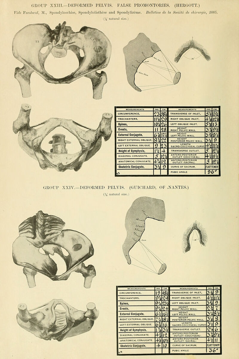 GROUP XXIII.—DEFORMED PELVIS. FALSE PROMONTORIES. (HERGOTT.) Vide Farabeuf, 31., Spondj'loschise, Spondylolisth&se and Spondj'liz^me. Bulletins de la SoeieU de cJiirurgie, 1S85. 04 mitural size.)    rr-t CIRCUMFERENCE, ?? 5%\ TRANSVERSE OF INLET, 5^i ml TROCHANTERS. II'i ?9 RIGHT OBLIQUE INLET, \h\'!}A Spines, 10!, ?6 LEFT OBLIQUE INLET ^Id |3l Crests, II es RIGHT PELVIC WALL. Xy\ m External Gorjugate, ^'« in LEFT ?lm J WALL, Vi^\\ RIGHT EXTERNAL OauQUE, d'4 ao POST^RlSStELViC WALL. 5'4 9 LEFT EXTERNAL OBLIQUE. 9 25 SACRO-COCC™ EAL CURVE 4? H'^ Height of Symphysis, \'-i 4- TRANSVERSE OUTLET, $ 12', DIAGONAL CONJUGATE. ? m *S;TLE°T';?Scvi?E''AL.. \'i i\'i ANATOMICAL CONJUGATE. A-% \<i *oJe°t™aJra'l°'' ^ 12 V Obstetric Conjugate, 5'< 9 CURVE OF SACRUM, fLATTENEol ■C> PUBIC ANGLE 96 \ GROUP XXIV.—DEFORMED PELVIS. (GUICHARD, OF ,NANTES.) (3^ natural size.)  TT T!?  CIRCUMFERENCE, If) m TRANSVERSE OF INLET, ?1f 9 TROCHANTERS. n ?-^ RIGHT OBLIQUE INLET 4'? ir« Spines, 9'-f 2?^ LEFT OBLIQUE INLET, ys 9 Crests, 9V ?+ R,GHtI'e°LvIc WALL. s^ T External Conjugate, fie Ifi LEFT pIlvVJ WALL, ?'* 8^- RIGHT EXTERNAL OBLIQUE, T'f If^'i POST?RlSS^PELVIO WALL, $'s tJ. LEFT EXTERNAL OBLIQUE <yy }(•' SACRO-clcc™EAL CURVE j'i <? Height of Symphysis, I'ff ?^ TRANSVERSE OUTLET. ?'4 6 DIAGONAL CONJUGATE n (^ ^Sutl°j''<°oIc'°m: J^^ 9'i ANATOMICAL CONJUGATE, 4-'s m ''SjTLE°r';iAjRAU.'' Vc II Obstetric Conjugate, 4- 10 CURVE OF SACRUM, fUTTENEcl I-* ^ ^