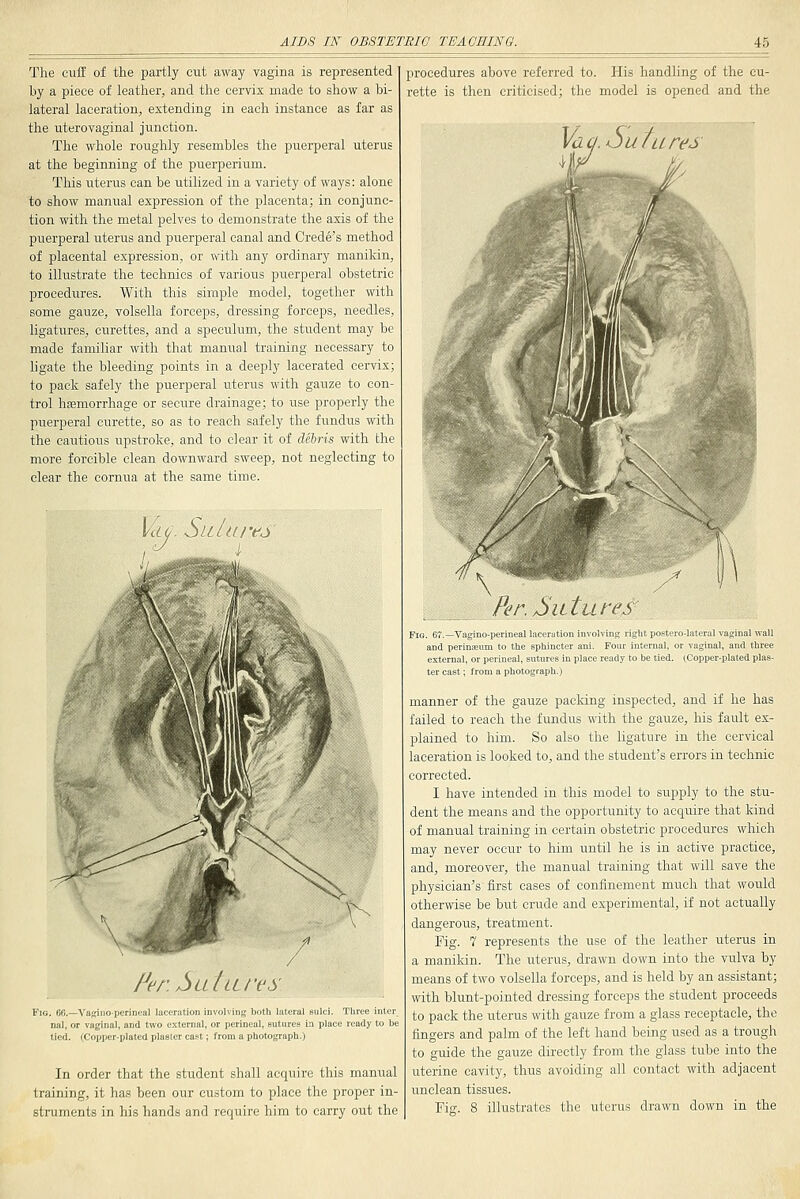 The cuff of the partly cut away vagina is represented by a piece of leather, and the cervix made to show a bi- lateral laceration, extending in each instance as far as the uterovaginal junction. The whole roughly resembles the puerperal uterus at the beginning of the puerperium. This uterus can be utilized in a variety of ways: alone to show manual expression of the placenta; in conjunc- tion with the metal pelves to demonstrate the axis of the puerperal uterus and puerperal canal and Crede's method of placental expression, or with any ordinary manikin, to illustrate the technics of various puerperal obstetric procedures. With this simple model, together with some gauze, volsella forceps, dressing forceps, needles, ligatures, curettes, and a speculum, the student may be made familiar with that manual training necessary to ligate the bleeding points in a deeply lacerated cervix; to pack safely the puerperal uterus with gauze to con- trol hjemorrhage or secure drainage; to use properly the puerperal curette, so as to reach safely the fundus with the cautious upstroke, and to clear it of debris with the more forcible clean downward sweep, not neglecting to clear the eornua at the same time. id6. ^LLlures I^enSaUu'es i, 60.—VaffiuO'Perineal laceration involving both lateral sulci. Three inter nal, or vaginal, and two external, or perineal, Butures in place ready to be tied. (Copper-plated plaster cast; from a photograph.) In order that the student shall acquire this manual training, it has been our custom to place the proper in- struments in his hands and require him to carry out the procedures above referred to. His handling of the cu- rette is then criticised; the model is opened and the ur&J Per. futures Fig. 67.—Vagino-perineal laceration in' and perinjenm to the sphincter an external, or perineal, sittures in pla ter cast; from a photograph.) )lviDg right po.«tero-lateral vaginal wall Four internal, or vaginal, and three i ready to be tied. (Copper-plated plas- manner of the gauze packing inspected, and if he has failed to reach the fundus with the gauze, his fault ex- plained to him. So also the ligature in the cervical laceration is looked to, and the student's errors in technic corrected. I have intended in this model to supply to the stu- dent the means and the opportunity to acquire that kind of manual training in certain obstetric procedures which may never occur to him until he is in active practice, and, moreover, the manual training that will save the physician's first eases of confinement much that would otherwise be but crude and experimental, if not actually dangerous, treatment. Fig. 7 represents the use of the leather uterus in a manikin. The uterus, drawn down into the vulva by means of two volsella forceps, and is held by an assistant; with blunt-pointed dressing forceps the student proceeds to pack the uterus with gauze from a glass receptacle, the fingers and palm of the left hand being used as a trough to guide the gauze directly from the glass tube into the uterine cavity, thus avoiding all contact with adjacent unclean tissues. Fis. 8 illustrates the uterus drawn down in the