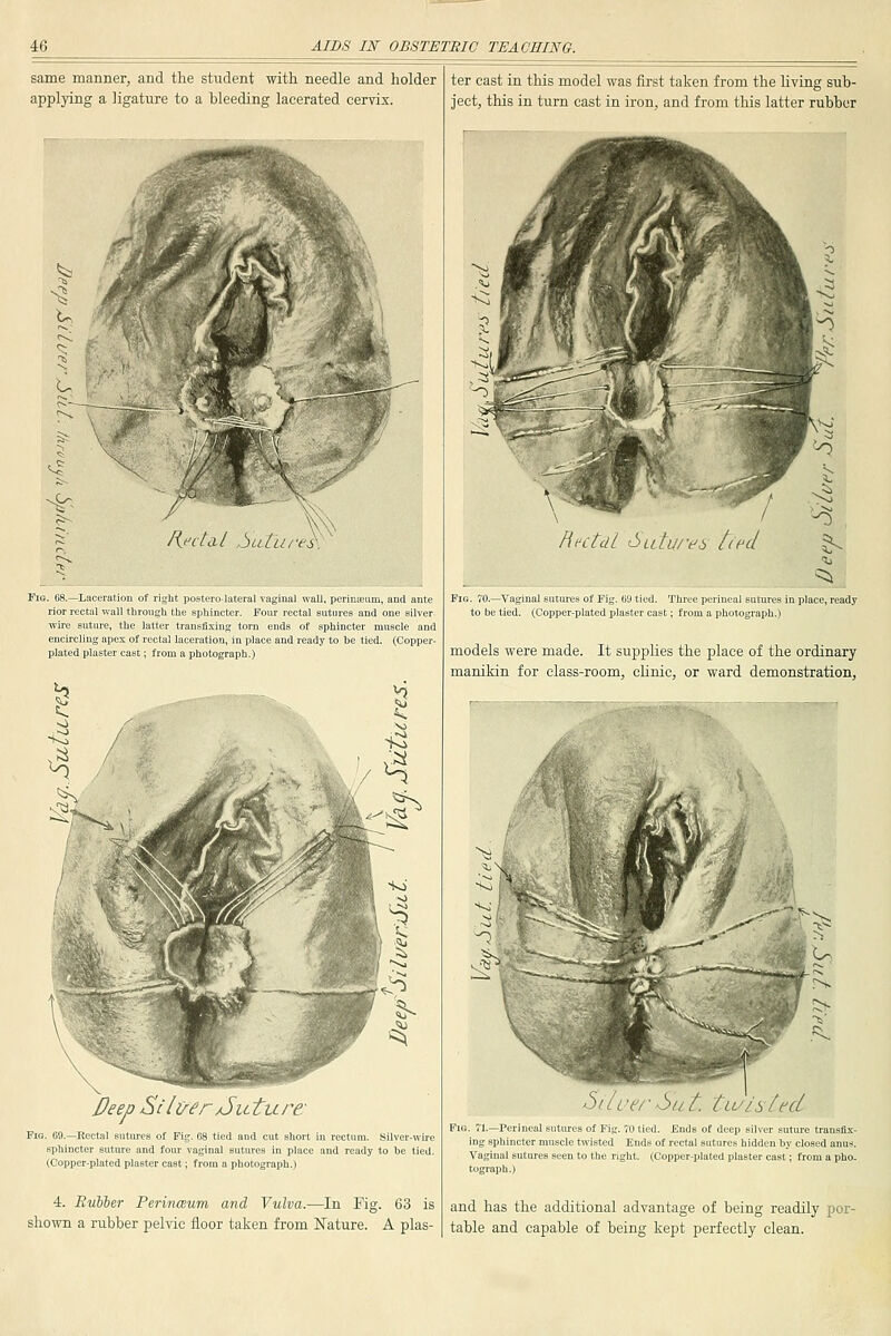 same manner, and the student with, needle and holder applying a ligature to a bleeding lacerated cervix. —Laceration of right postero-iateral vaginal wall, perinseum, and ante rior rectal wall througli the sphincter. Four rectal sutures and one silver wire suture, the latter tranefixins torn ends of sphincter muscle and encircling apes of rectal laceration, in place and ready to be tied. (Copper- plated plaster cast; from a photograph.) Deep ^ i Iver /^uZure' FiQ. 69.—Rectal sutiu-es of Fig. 08 tied and cut short in rectum. Silver-wire sphincter suture and four vaginal sutures in place and ready to be tied. (Copper-plated plaster cast; from a photograph.) 4. Ritiier Perinasum and Vulva.—In Fig. 63 is shown a rubber pelvic floor taken from Nature. A plas- ter cast in this model was first taken from the living sub- ject, this in turn cast in iron, and from this latter rubber Pig. 70.—Vaginal to be tied. (Copper-plated plaster cast; from a photograph.) models were made. It supplies the place of the ordinary manikin for class-room, chnic, or ward demonstration. A tLulsted Pig. 71.—Perineal sutures of Fig. 70 tied. Ends of deep silver suture transfix- ing sphincter muscle twisted Ends of rectal sutures hidden by closed anus. Vaginal sutures seen to the right. (Copper-plated plaster cast; from a pho. tograph.) and has the additional advantage of being readily por- table and capable of being kept perfectly clean.