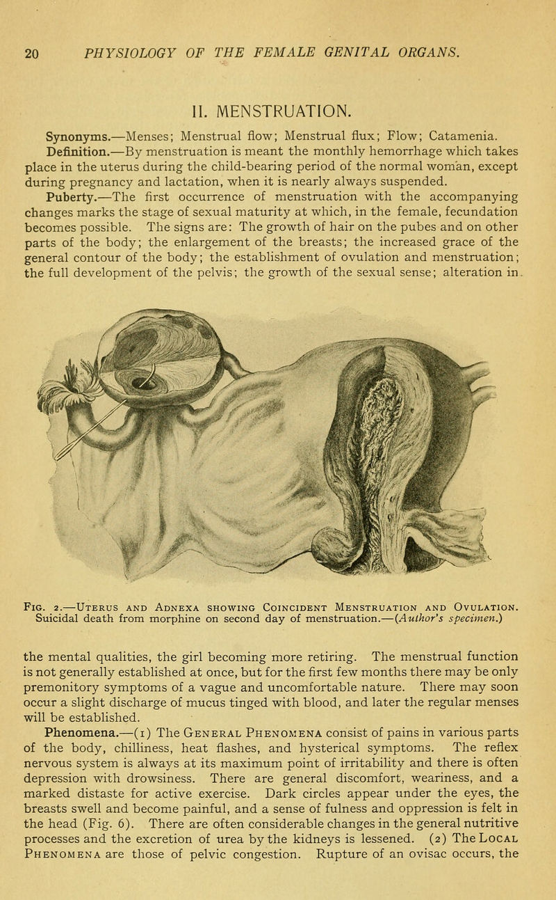 II. MENSTRUATION. Synonyms.—Menses; Menstrual flow; Menstrual flux; Flow; Catamenia. Definition.—By menstruation is meant the monthly hemorrhage which takes place in the uterus during the child-bearing period of the normal woman, except during pregnancy and lactation, when it is nearly always suspended. Puberty.—The first occurrence of menstruation with the accompanying changes marks the stage of sexual maturity at which, in the female, fecundation becomes possible. The signs are: The growth of hair on the pubes and on other parts of the body; the enlargement of the breasts; the increased grace of the general contour of the body; the establishment of ovulation and menstruation; the full development of the pelvis; the growth of the sexual sense; alteration in. Fig. 2.—Uterus and Adnexa showing Coincident Menstruation and Ovulation. Suicidal death from morphine on second day of menstruation.—(Author's specimen.) the mental qualities, the girl becoming more retiring. The menstrual function is not generally established at once, but for the first few months there may be only premonitory symptoms of a vague and uncomfortable nature. There may soon occur a slight discharge of mucus tinged with blood, and later the regular menses will be established. Phenomena.—(i) The General Phenomena consist of pains in various parts of the body, chilliness, heat flashes, and hysterical symptoms. The reflex nervous system is always at its maximum point of irritability and there is often depression with drowsiness. There are general discomfort, weariness, and a marked distaste for active exercise. Dark circles appear under the eyes, the breasts swell and become painful, and a sense of fulness and oppression is felt in the head (Fig. 6). There are often considerable changes in the general nutritive processes and the excretion of urea by the kidneys is lessened. (2) The Local Phenomena are those of pelvic congestion. Rupture of an ovisac occurs, the