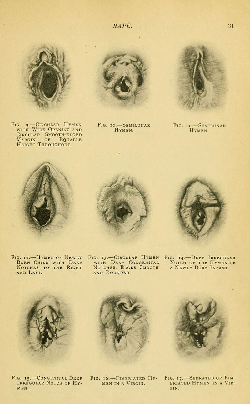 Fig. 9.—Circular Hymen WITH Wide Opening and Circular Smooth-edged Margin of Equable Height Throughout, Fig. 10.—Semilunar Hymen. Fig. II.—Semilunar Hymen. ,. if^^' Fig. 12.—Hymen of Newly Fig. 13.—Circular Hymen Fig. 14.—Deep Irregular Born Child with Deep with Deep Congenital Notch of the Hymen of Notches to the Right Notches. Edges Smooth a Newly Born Infant. AND Left. and Rounded. Fig. 15.—Congenital Deep Irregular Notch of Hy- men. Fig. 16.—Fimbriated Hy- men in a Virgin. Fig. 17.—Serrated or Fim- briated Hymen in a Vir- gin.