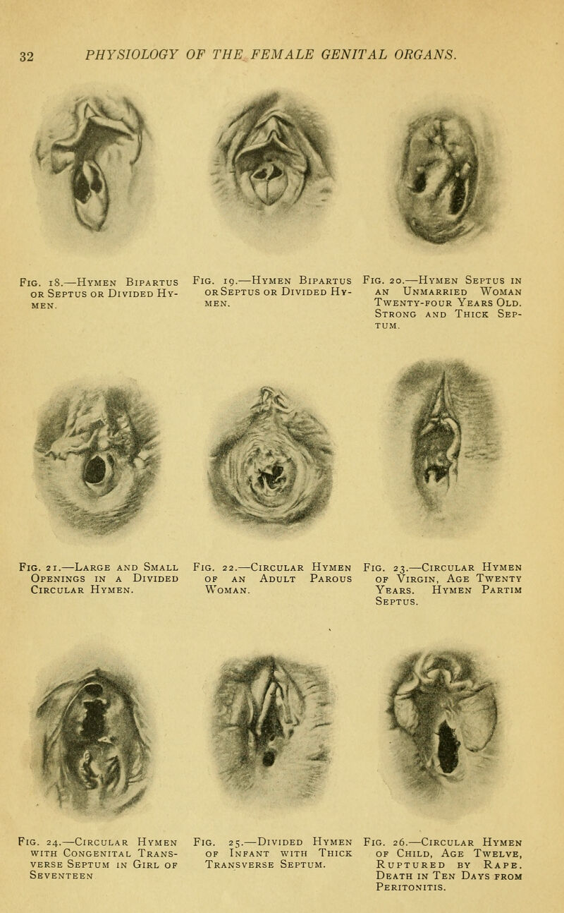 Fig. i8.—Hymen Bipartus OR Septus or Divided Hy- men. Fig. 19.—Hymen Bipartus orSeptus or Divided Hy- men. Fig. 20.—Hymen Septus in AN Unmarried Woman Twenty-four Years Old. Strong and Thick Sep- tum. P^^. T^l'Cf Fig. 21.—Large and Small Openings in a Divided Circular Hymen. Fig. 22.—Circular Hymen Fig. 23.—Circular Hymen OF AN Adult Parous of Virgin, Age Twenty Woman. Years. Hymen Partim Septus. Fig. 24.—Circular Hymen with Congenital Trans- verse Septum in Girl of Seventeen Fig. 25.—Divided Hymen Fig. 26.—Circular Hymen of Infant with Thick of Child, Age Twelve, Transverse Septum. Ruptured by Rape. Death in Ten Days from Peritonitis.