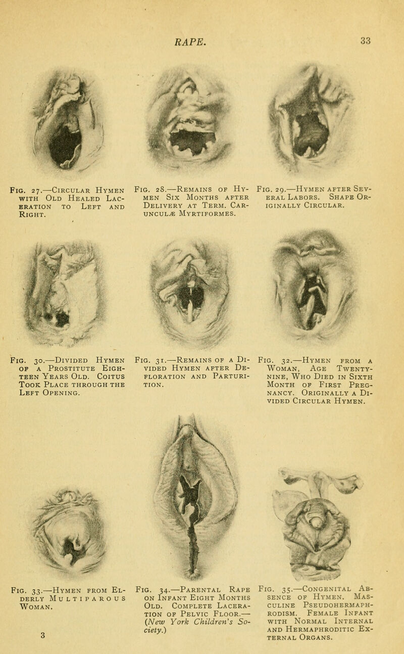 Fig. 27.—Circular Hymen WITH Old Healed Lac- eration TO Left and Right. Fig. 28.—Remains of Hy- Fig. 29.—Hymen after Sev- MEN Six Months after eral Labors. Shape Or- Delivery at Term. Car- iginally Circular. UNCULiE MyRTIFORMES. Fig. 30.—Divided Hymen OF A Prostitute Eigh- teen Years Old. Coitus Took Place through the Left Opening. Fig. 31.—Remains of a Di- vided Hymen after De- floration AND Parturi- tion. Fig. 32.—Hymen from a Woman, Age Twenty- nine, Who Died in Sixth Month of First Preg- nancy. Originally a Di- vided Circular Hymen. .^^i^.y-*- FiG. 33.—Hymen from El- derly Multiparous Woman. Fig. 34.—Parental Rape ON Infant Eight Months Old. Complete Lacera- tion OF Pelvic Floor.— (New York Children's So- ciety.) -# r~ --•>* Fig. 35.—Congenital Ab- sence OF Hymen. Mas- culine PSEUDOHERMAPH- rodism. Female Infant WITH Normal Internal AND Hermaphroditic Ex- ternal Organs.