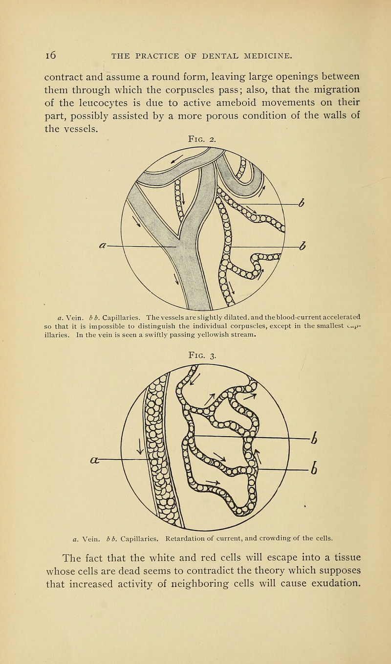 contract and assume a round form, leaving large openings between them through which the corpuscles pass; also, that the migration of the leucocytes is due to active ameboid movements on their part, possibly assisted by a more porous condition of the walls of the vessels. Fig. 2. a. Vein. bb. Capillaries. The vessels are slightly dilated, and the blood-current accelerated so that it is impossible to distinguish the individual corpuscles, except in the smallest (.u^j- illaries. In the vein is seen a swiftly passing yellowish stream. Fig. 3. a. Vein. bb. Capillaries. Retardation of current, and crowding of the cells. The fact that the white and red cells will escape into a tissue whose cells are dead seems to contradict the theory which supposes that increased activity of neighboring cells will cause exudation.
