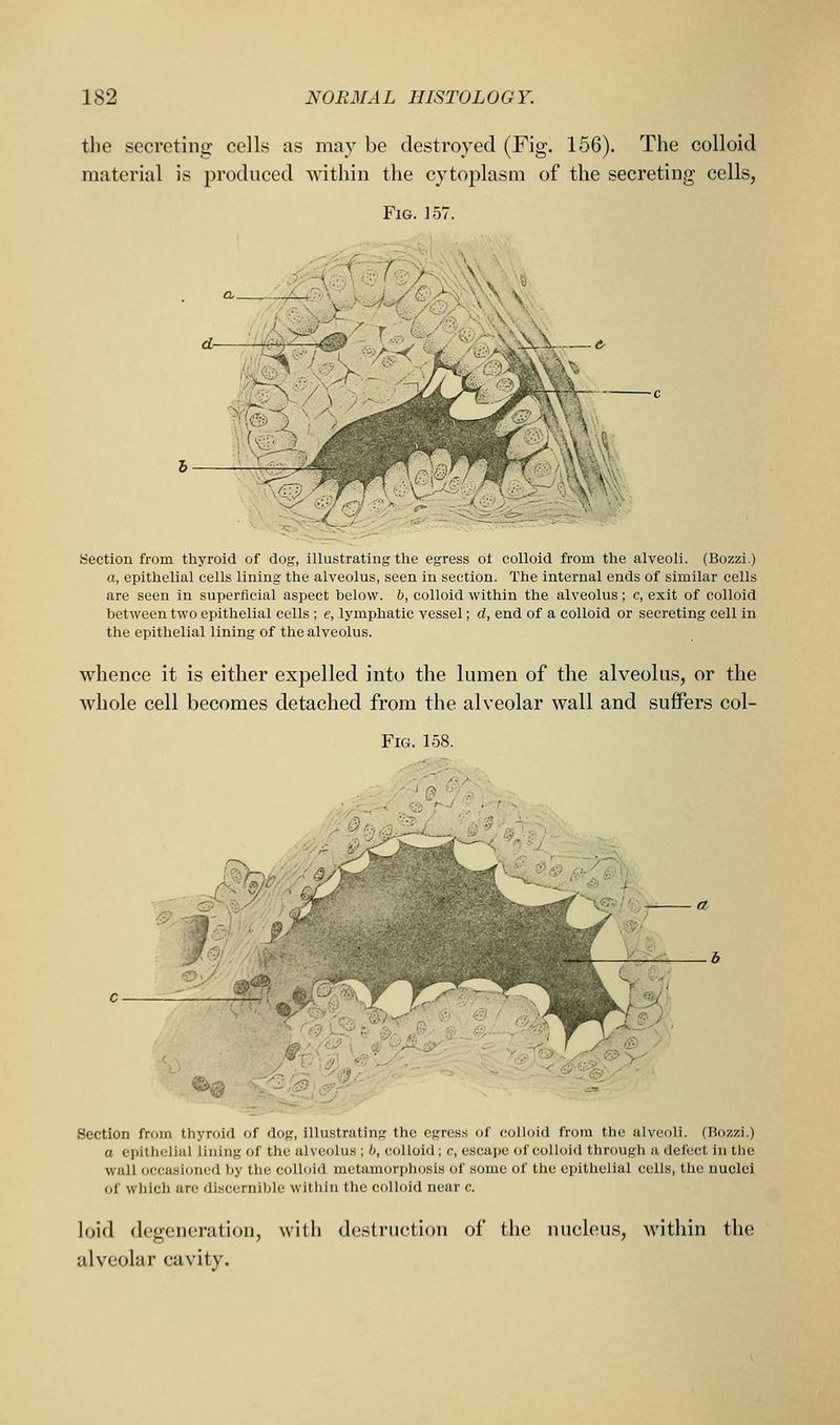 the secreting cells as may be destroyed (Fig. 156). The colloid material is produced within the cytoplasm of the secreting cells, Fig. 157. Section from thyroid of dog, illustrating the egress ol colloid from the alveoli. (Bozzi.) a, epithelial cells lining the alveolus, seen in section. The internal ends of similar cells are seen in superficial aspect below, b, colloid within the alveolus ; c, exit of colloid between two epithelial cells ; e, lymphatic vessel; d, end of a colloid or secreting cell in the epithelial lining of the alveolus. whence it is either expelled into the lumen of the alveolus, or the whole cell becomes detached from the alveolar wall and suffers col- FiG. 158. Section from thyroid of dog, illustrating the egress of colloid from tlie alveoli. (Bozzi.) a epithelial lining of the alve(jlus ; b, colloid ; c, escape of colloid through a defect in the wall occasioned tjy the colloid mctamorpliosis of some of the epithelial cells, the nuclei of which are discernible within the colloid near c. loid degeneration, with destruction of the nucleus, Avithin the alveolar cavity.