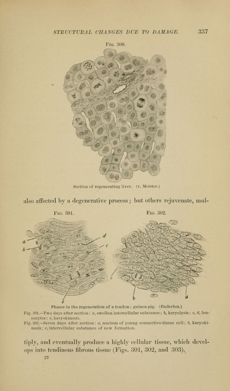 !M(i :!M(i. 4 M--.^:^' ip. <ry^ Section of regenerating liver, (v. Meister.) iilso atfectod by a degenerative process; but otliers rejuvenate, mul- FiG. 302. FiG. 301. •:>^^ 3v^-- K<rvvvt? b Phases in the rcKeneration of a tendon ; guinoa-pig. (Enderlen.) Fig. oOl.—Two days alter section : o, swollen intercellular substance; 6, karyolysis ; c, d, leu- cocytes; e, karyokinesis. Fig. 302.—Seven days after section : a, nucleus of young connective-tissue cell; 6, karyoki- nesis; c, intercellular substance of new formation. tiply, and eventually ])n>duee a highly cellular tissue, which devel- ops into tendinous fibrous tissue (Figs. 301, 302, and 303). 22