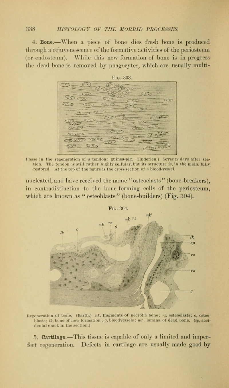 4. Bone.—Wlien a piece of boue dies fresh bone is produced through a rejuvenescence of the formative activities of the periosteum (or endosteura). While this new formation of bone is in progress tlie dead bone is removed by phagocj'tes, which are usually multi- FiG. 303. Phase in the regeneration of a tendon; guinea-pig. (Enderlen.) Seventy days after sec- tion. The tendon is still rather highly cellular, but its structure is, in the main, fully restored. At the top of the figure is the cross-section of a blood-vessel. nucleated, and have received the name '' osteoclasts (bone-breakers), in contradistinction to the bone-forming cells of the periosteum, which are known as  osteoblasts  (bone-builders) (Fig. 304). Fig. 304. t\k 'f? nh t ff Ih •fc H III , Ik sp Regeneration of bone. (Barth.) nk, fragments of necrotic bone; rz, osteoclasts; o, osteo- blasts ; Ik, bone of new formation : y, bloodvessels ; nk', lamina of dead bone, (sp, acci- dental crack in the section.) 5. Cartilage.—This tissue is ca])ablc of only a limited and imper- fect regeneration. Defects in cartilage are usually made good by