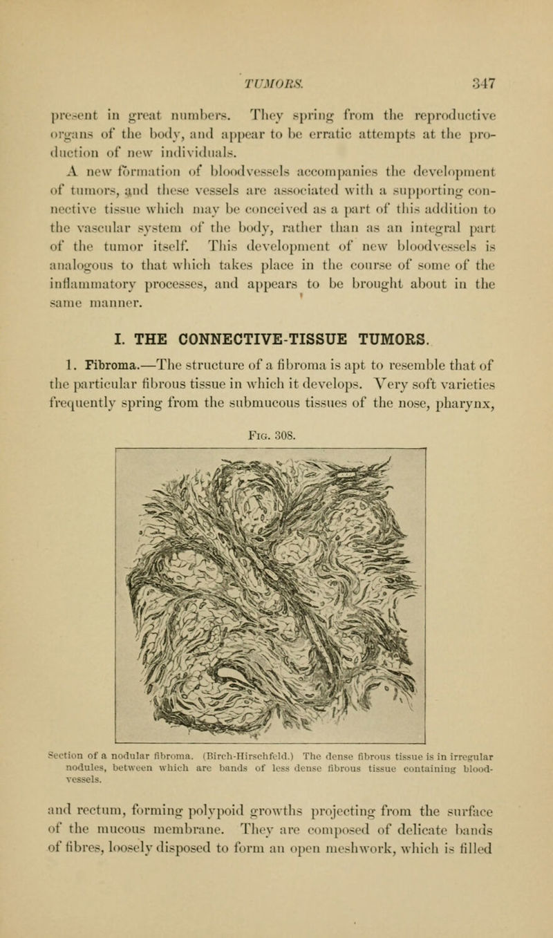 present in great numbers. Tlicy spring from the reproductive organs of the body, and ap[)ear to i)e erratic attempts at tlie pro- thiction of new imUvidnals. A new fr)rniation of bloodvessels accompanies the development of tumors, and these vessels are associated with a supporting con- nective tissue which may be conceived as a })art of tliis addition to the vascular system of the bitdy, rather than as an integral part of the tumor itself. Tliis development of new bloodvessels is analogous to that which takes place in the course of some of the inflammatory processes, and appears to be brought about in the same manner. I. THE CONNECTIVE-TISSUE TUMORS. 1. Fibroma.—The structure of a fibroma is apt to resemble that of the particular fibrous tissue in which it develops. Very soft varieties frequently spring from the submucous tissues of the nose, pharynx, Fig. 308. Section of a nodular fibroma. (Birc-h-Hirschfelil.) The dense fibrous tissue is in irregular nodules, between which are bands of less dense fibrous tissue containitig blood- vessels. and rectum, forming polypoid growths projecting from the surface of the mucous membrane. They are composed of delicate bands of fibres, loosely disposed to form an oi)en meshwork, mIucIi is filled
