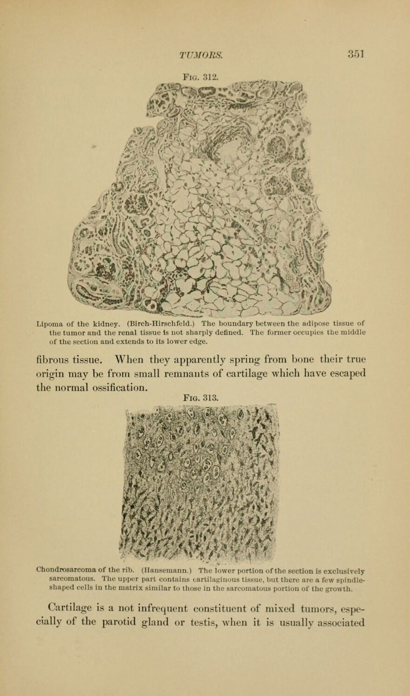 Fi(i. 312. ^^6 Lipoma of the kidney. (Birch-IIirschfeld.) The boundary between the adipose tissue of the tumor and the renal tissue Is not sharply defined. The former occupies the middle of the section and extends to its lower edge. fibrous tissue. When they apparently spring from hone their true origin may be from small remnants of cartilage which have escaped the normal ossification. m WMW^' Chondrosarcoma of the rib. (Hansemann.) The lower portion of the section is exclusively sarcomatous. The upper part contains cartilaginous tissue, but there are a few spindle- shaped cells in the matrix similar to those in the sarcomatous portion of the growth. Cartilage is a not infrequent constituent of mixed tumors, espe- cially of the parotid gland or testis, when it is usually associated