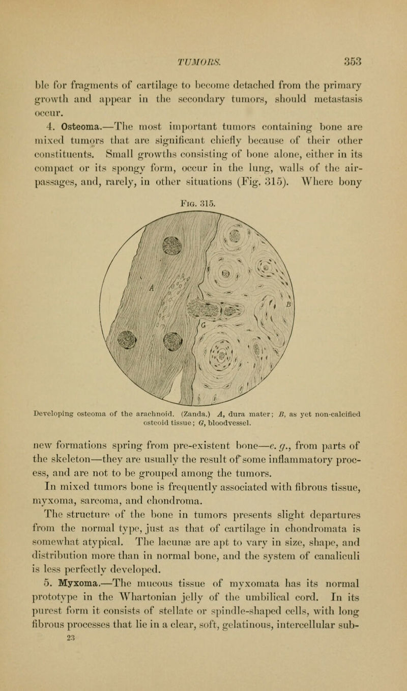bio for fraf>;rncnts of cartilage to become detached from the primary growth and appear in the secondary tumors, shotdd metastasis occur. 4. Osteoma.—Tlie most important tumors containing bone are mixed tumors that an; significant chieHy because of their other (ionstituents. Small growths consisting of bone alone, either in its compact or its spongy form, occur in the lung, walls of the air- passages, and, rarely, in other situations (Fig. 315). Where bony Fi(i. :;io. Developing osteoma of the arachnoid. (Zanda.) A, dura mater; B, as yet non-calcified osteoid tissue ; G, bloodvessel. new formations spring from pre-existent bone—r. r/., from parts of the skeleton—they are usually the result of some inflammatory proc- ess, and are not to be grouped among the tumors. In mixed tumors bone is frequently associated with fibrous tissue, myxoma, sarcoma, and chondroma. The structure of the bone in tumors presents slight departures from the normal type, just as that of cartilage in chondromata is somewhat atypical. The lacunse are apt to vary in size, shaj)e, and distribution more than in normal bone, and the system of canaliculi is less perfectly developed. 5. Myxoma.—The mucous tissue of myxomata has its normal prototype in the Whartonian jelly of the umbilical cord. In its purest form it consists of stellate or s])indle-shape(l cells, with long fibrous processes that lie in a clear, soft, gelatinous, intercellular sub- 23