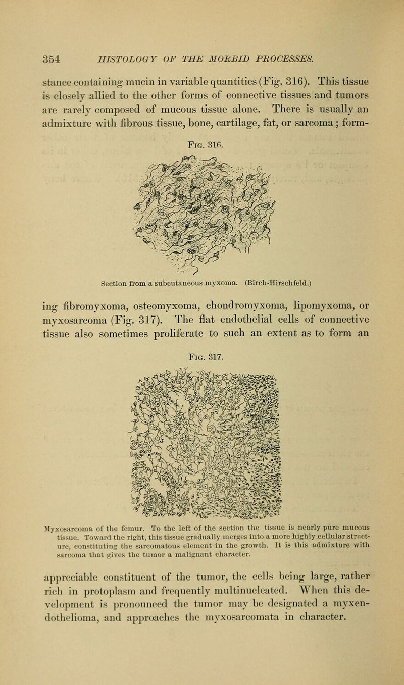 stance containing mucin in variable quantities (Fig. 316). This tissue is closely allied to the other forms of connective tissues and tumors are rarely composed of mucous tissue alone. There is usually an admixture with fibrous tissue, bone, cartilage, fat, or sarcoma; form- FiG. 316. Section from a subcutaneous myxoma. (Birch-Hirschfeld.) ing fibromyxoma, osteomyxoma, chondromyxoma, lipomyxoma, or myxosarcoma (Fig. 317). The flat endothelial cells of connective tissue also sometimes proliferate to such an extent as to form an Fig. 317. Myxosarcoma of the femur. To the left of the section the tissue is nearly pure mucous tissue. Toward the right, this tissue gradually merges into a more highly cellular struct- ure, constituting the sarcomatous element in the growth. It is this admixture with sarcoma that gives the tumor a malignant character. appreciable constituent of the tumor, the cells being large, rather rich in protoplasm and frequently multinucleated. When this de- velopment is pronounced the tumor may be designated a myxen- dothelioma, and approaches the myxosarcomata in character.