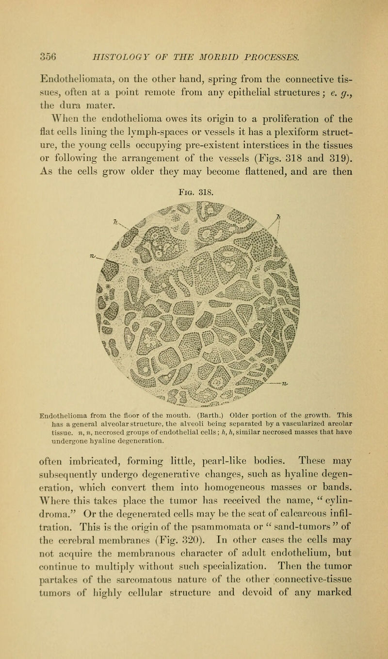 Endotheliomata, on the other haud^ spring from the connective tis- sue;;, often at a point remote from any epithelial structures; e. g., the dura mater. When the endothelioma owes its origin to a proliferation of the flat cells lining the lymph-spaces or vessels it has a plexiform struct- ure, the young cells occupying pre-existent interstices in the tissues or following the arrangement of the vessels (Figs. 318 and 319). As the cells grow older they may become flattened, and are then Fig. 318. Endothelioma from the floor of the mouth. (Barth.) Older portion of the growth. This has a general alveolar structure, the alveoli being separated by a vascularized areolar tissue, n, n, necrosed groups of endothelial cells; h, h, similar necrosed masses that have undergone hyaline degeneration. often imbricated, forming little, pearl-like bodies. These may subsequently undergo degenerative changes, such as hyaline degen- eration, which convert them into homogeneous masses or bands. Where this takes place the tumor has received the name,  cylin- droma. Or the degenerated cells may })e the scat of calcareous infil- tration. This is the origin of the ])samm()mata or  saud-tumors  of the cerebral membranes (Fig. 320). In other cases the cells may not acquire the membranous character of adult endotlielium, but continue to multiply witliout such specialization. Tlien the tumor partakes of the sarcomatous nature of the other connective-tissue tumors of higlily cellular structure and devoid of any marked
