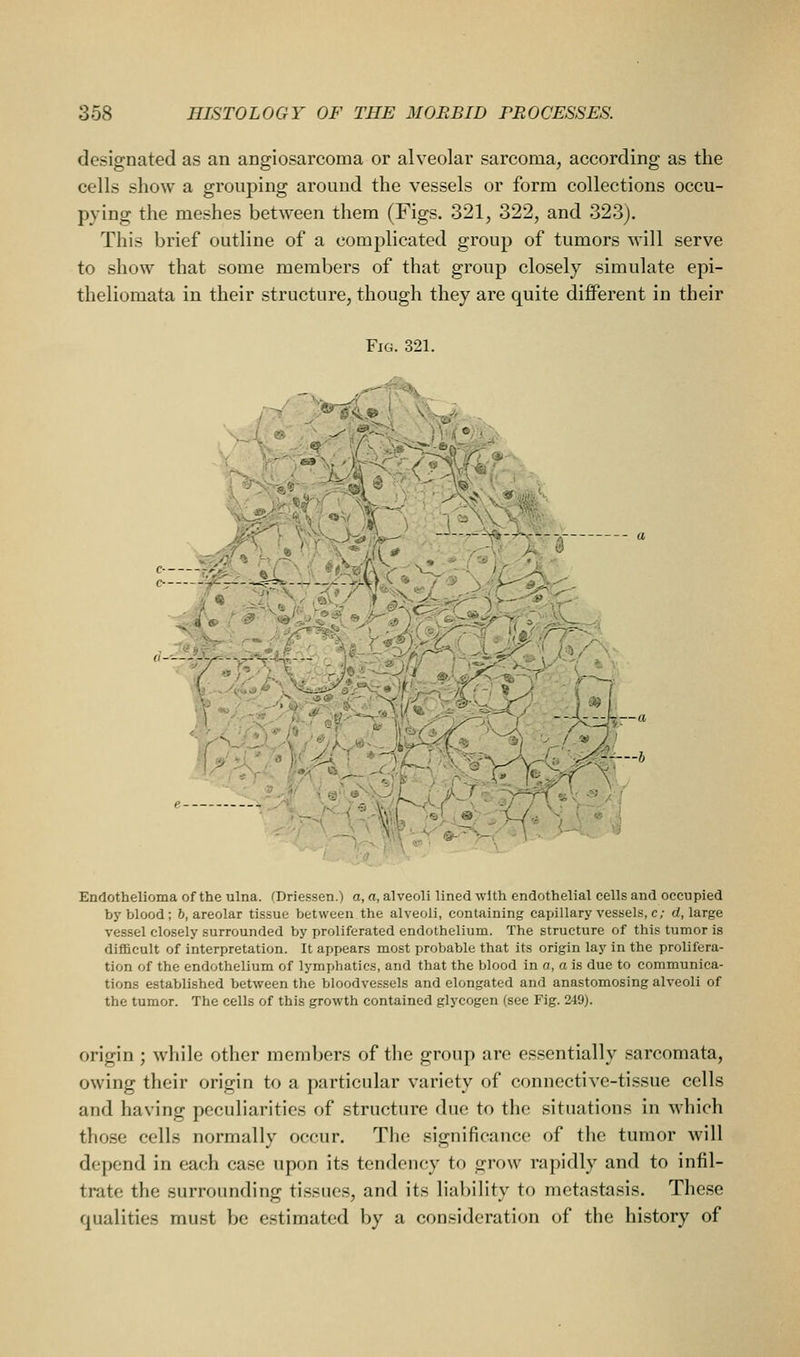 designated as an angiosarcoma or alveolar sarcoma, according as the cells show a grouping around the vessels or form collections occu- pying the meshes between them (Figs. 321, 322, and 323). This brief outline of a complicated group of tumors M'ill serve to show that some members of that group closely simulate epi- theliomata in their structure, though they are quite diflPerent in their Fig. 321. Endothelioma of the ulna. (Driessen.) a, a, alveoli lined with endothelial cells and occupied by blood; 6, areolar tissue between the alveoli, containing capillary vessels, c; (/.large vessel closely surrounded by proliferated endothelium. The structure of this tumor is difficult of interpretation. It appears most probable that its origin lay in the prolifera- tion of the endothelium of lymphatics, and that the blood in a, a is due to communica- tions established between the bloodvessels and elongated and anastomosing alveoli of the tumor. The cells of this growth contained glycogen (see Fig. 249). origin ; while other members of the group are essentially sarcomata, owing their origin to a particular variety of connective-tissue cells and having peculiarities of structure due to the situations in which those cells normally occur. The significance of the tumor will depend in each case upon its tendency to grow rapidly and to infil- trate the surrounding tissues, and its liability to metastasis. These qualities must be estimated by a consideration of the history of