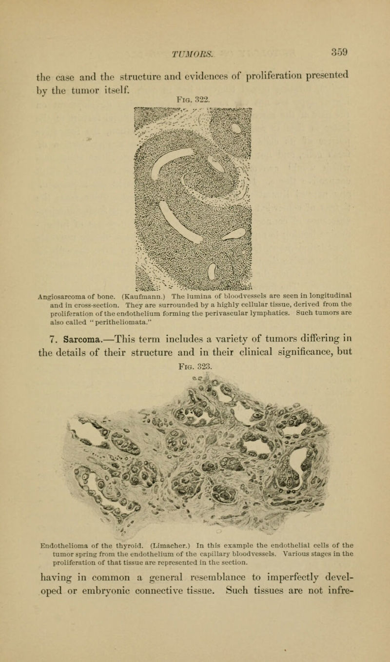 the case and the structure and evidences of proliferation presented by tlie tumor itself. Fig. 822. W -0f ^^^*^i^ A^ m Angiosarcoma of bone. (Kaufmann.) The lumina of bloodvessels are seen in longitudinal and in cross-section. They are surrounded by a highly cellular tissue, derived from the proliferation of the endothelium forming the perivascular lymphatics. Such tumors are also called  peritheliomata. 7. Sarcoma.—This term includes a variety of tumors differing in the details of their structure and in their clinical significance, but Fig. 323. fv f^±^k.. ~^, -^^' Endothelioma of the thyroid. (Limacher.) In this example the endothelial cells of the tumor spring from the endothelium of the capillary bloodvessels. Various stages in the proliferation of that tissue are represented in the section. having in common a general resemblance to imperfectly devel- oped or embryonic connective tissue. Such tissues are not infre-