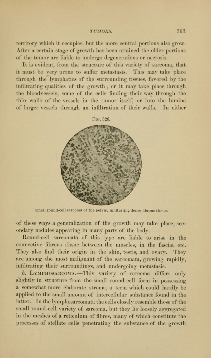 territory whioli it occupies, but the more central portions also^row. After a certain stage of growth has been attained the older portions of the tumor are liable to undergo degenerations or necrosis. It is evident, from the structure of this variety of sarcoma, that it must be very prone to suffer metastasis. This may take place through the lymphatics of the surrounding tissues, favored l)y the infiltrating qualities of the growth; or it may take place through the bloodvessels, some of the cells finding their way through the thin walls of the vessels in the tumor itself, or into the luniina of larger vessels through an infiltration of their walls. In either Fig. 326. r,\*\ Small round-cell sarcoma of the pelvis, infiltrating dense fibrous tissue. of these ways a generalization of the growth may take place, sec- ondary nodules appearing in many parts of the body. Round-cell sarcomata of this type are liable to arise in the connective fibrous tissue between the muscles, in the fascia?, etc. They also find their origin in the skin, testis, and ovary. They are among the most malignant of the sarcomata, growing rapidly, infiltrating their surroundings, and undergoing metastasis. b. Lymphosarcoma.—This variety of sarcoma differs only slightly in structure from the small round-cell form in possessing a somewhat more elaborate stroma, a term which could hardly be applied to the small amount of intercellular substance found in the latter. In the lymphosarcomata the cells closely resemble those of the small round-cell variety of sarcoma, but they lie loosely aggregated in the meshes of a reticulum of fibres, many of which constitute the processes of stellate cells penetrating the substance of the growth