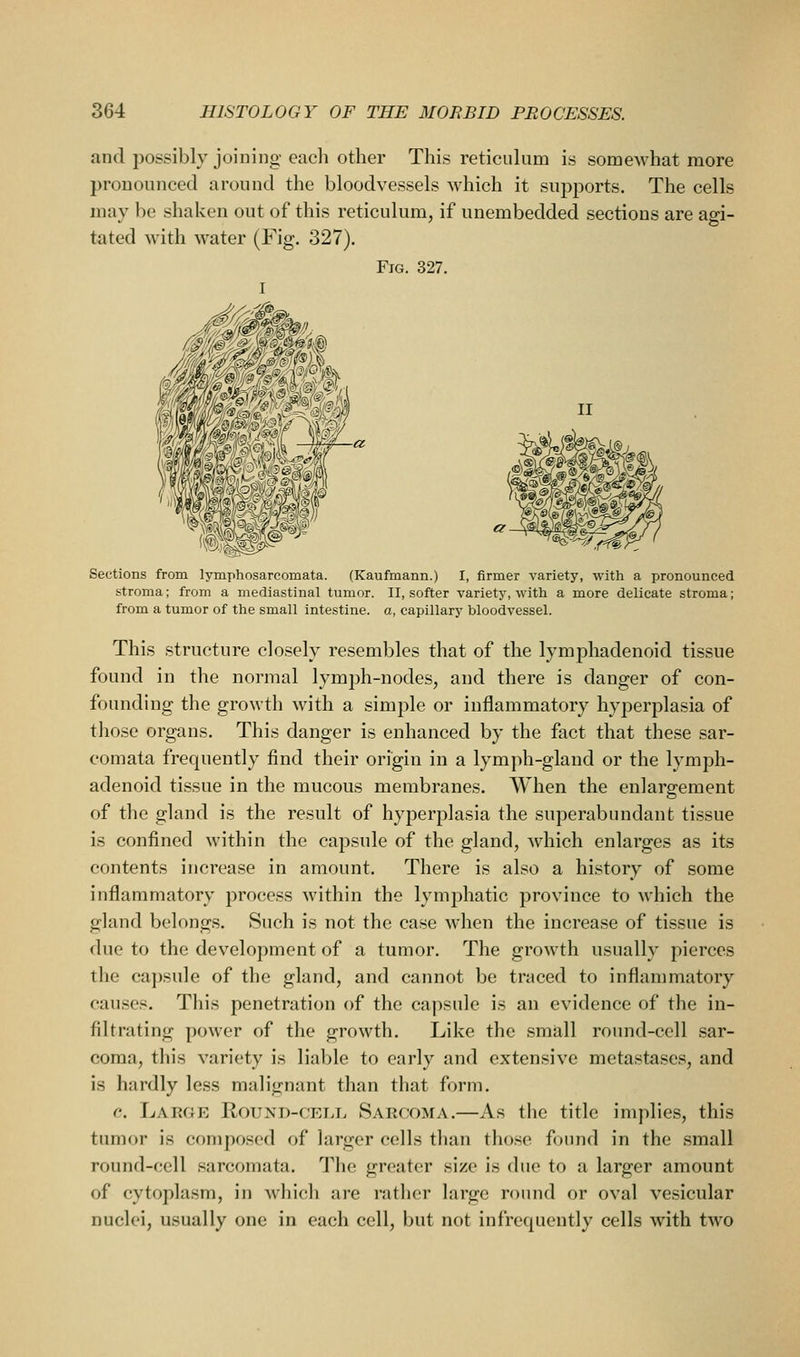 and possibly joining each other This reticiihim is somewhat more pronounced around the bloodvessels which it supports. The cells may be shaken out of this reticulum, if unembedded sections are agi- tated with water (Fig. 327). Fig. 327. I II Sections from lymphosarcomata. (Kaufmann.) I, firmer variety, with a pronounced stroma; from a mediastinal tumor. II, softer variety, with a more delicate stroma; from a tumor of the small intestine, a, capillary bloodvessel. This structure closely resembles that of the lymphadenoid tissue found in the normal lymph-nodes, and there is danger of con- founding the growth with a simple or inflammatory hyperplasia of those organs. This danger is enhanced by the fact that these sar- comata frequently find their origin in a lymph-gland or the lymph- adenoid tissue in the mucous membranes. When the enlargement of the gland is the result of hyperplasia the superabundant tissue is confined within the capsule of the gland, which enlarges as its contents increase in amount. There is also a history of some inflammatory process within the lymijhatic province to which the gland belongs. Such is not the case when the increase of tissue is due to the development of a tumor. The growth usually pierces the capsule of the gland, and cannot be traced to inflammatory causes. This penetration of the capsule is an evidence of the in- filtrating power of the growth. Like the small round-cell sar- coma, this variety is lialjle to early and extensive metastases, and is hardly less malignant than that form. c. Laege Round-cell Sarcoma.—As the title implies, this tumor is composed of larger cells than tho.se found in the small round-cell sarcomata. The greater size is due to a larger amount of cytoplasm, in which are rather large round or oval vesicular nuclei, usually one in each cell, but not infrequently cells with two