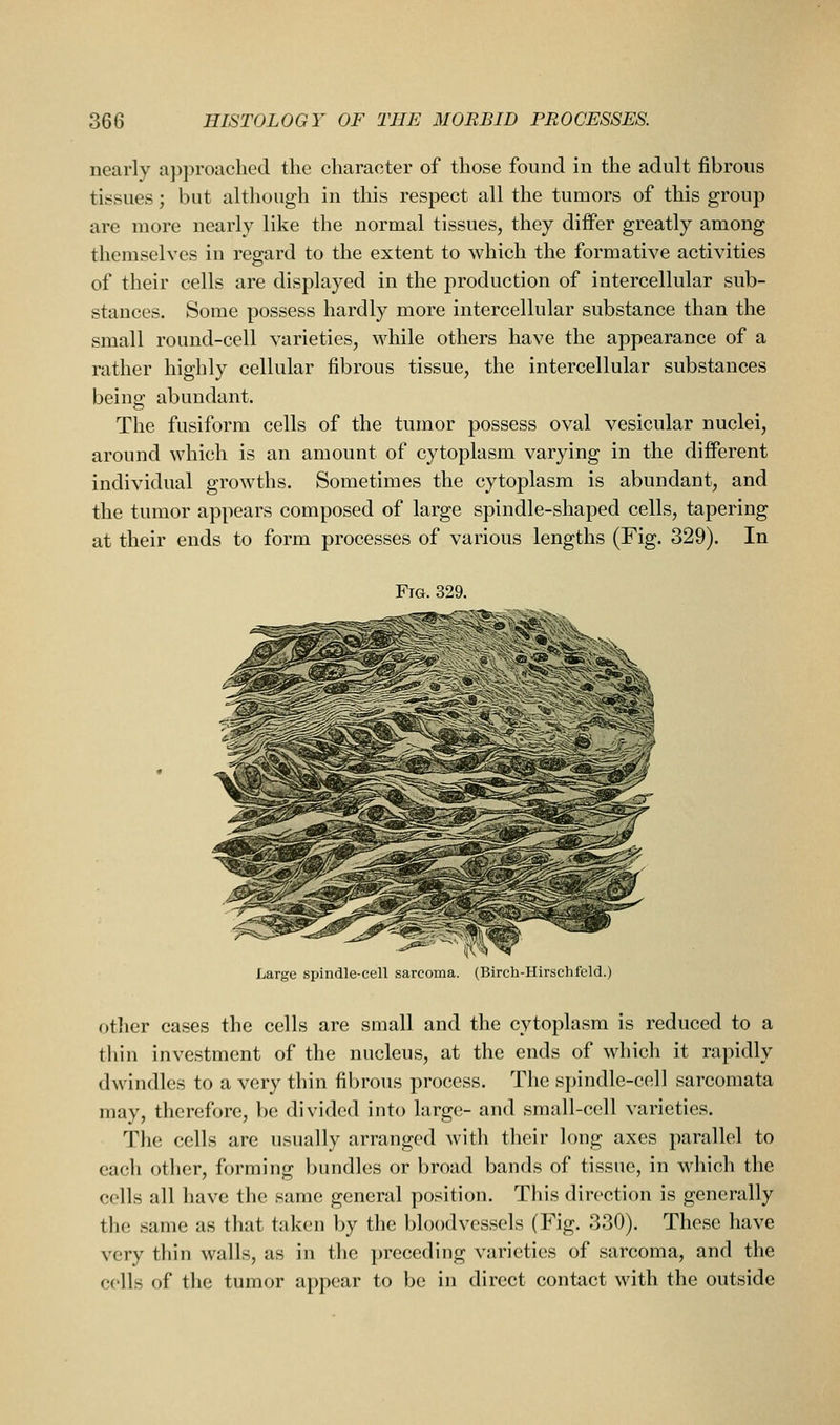 nearly approached the character of those found in the adult fibrous tissues; but although in this respect all the tumors of this group are more nearly like the normal tissues, they differ greatly among themselves in regard to the extent to which the formative activities of their cells are displayed in the production of intercellular sub- stances. Some possess hardly more intercellular substance than the small round-cell varieties, while others have the appearance of a rather highly cellular fibrous tissue, the intercellular substances beiuff abundant. The fusiform cells of the tumor possess oval vesicular nuclei, around which is an amount of cytoplasm varying in the different individual growths. Sometimes the cytoplasm is abundant, and the tumor appears composed of large spindle-shaped cells, tapering at their ends to form processes of various lengths (Fig. 329). In Fig 329. Large spindle-cell sarcoma. (Birch-Hirschfeld.) other cases the cells are small and the cytoplasm is reduced to a thin investment of the nucleus, at the ends of which it rapidly dwindles to a very thin fibrous process. The spindle-cell sarcomata may, therefore, be divided into large- and small-cell varieties. The cells are usually arranged with their long axes parallel to each other, forming bundles or broad bands of tissue, in which the cells all have the same general position. This direction is generally the same as that taken by the bloodvessels (Fig. 330). These have very thin walls, as in the preceding varieties of sarcoma, and the cells of the tumor appear to be in direct contact with the outside