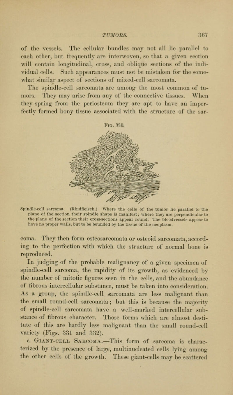 of the vessels. The cellular htindles may not all lie parallel to ea{;h other, but fVecjuently are iuteruovcn, so that a given section will contain longitmlinal, cross, and oblique sections of the indi- vidual cells. Such appearances must not be mistaken for the .some- what similar aspect of sections of mixed-cell sarcomata. The spindle-cell sarcomata are among the most common of tu- mors. They may arise from any of the connective tissues. When they spring from the periosteum they are apt to have an imper- fectly formed bony tissue associated with the structure of the sar- FiG. 330. '^ Spindle-cell sarcoma. (Rindfleisch.) Where the cells of the tumor lie parallel to the plane of the section their spindle shape is manifest; where they are perpendicular to the plane of the section their cross-sections appear round. The bloodvessels appear to have no proper walls, but to be bounded by the tissue of the neoplasm. coma. They then form osteosarcomata or osteoid .sarcomata, accord- ing to the perfection with which the structure of normal bone is reproduced. In judging of the probable malignancy of a given specimen of spindle-cell sarcoma, the rapidity of its growth, as evidenced by the number of mitotic figures seen in the cells, and the abundance of fibrous intercellular substance, must be taken into consideration. As a group, the spindle-cell sarcomata are less malignant than the small round-cell sarcomata; but this is because the majority of spindle-cell sarcomata have a well-marked intercellular sub- stance of fibrous character. Those forms which are almost desti- tute of this are hardly less malignant than the small round-cell variety (Figs. 331 and 332). e. GiAXT-CELL Sarcoma.—This form of sarcoma is charac- terized by the presence of large, multinucleated cells lying among the other cells of the growth. These giant-cells may be scattered