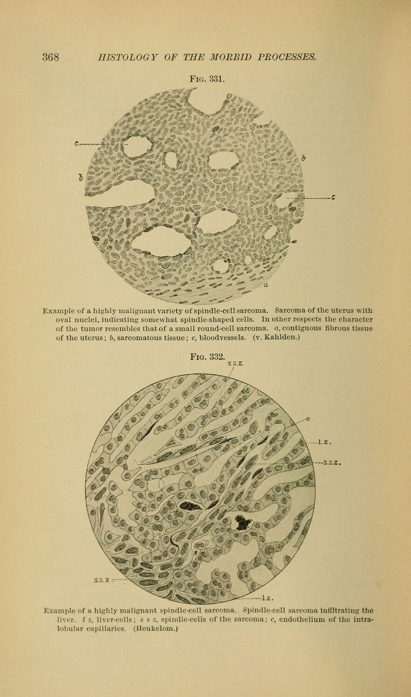 Fig. 331. il«j' ?i.i'7%''^ -^J Example of a highly malignant variety of spindle-cell sarcoma. Sarcoma of the uterus with oval nuclei, indicating somewhat spindle-shaped cells. In other respects the character of the tumor resembles that of a small round-cell sarcoma, a, contiguous fibrous tissue of the uterus; 6, sarcomatous tissue; c, bloodvessels, (v. Kahlden.) Fig. 832. Example of a highly malignant sjiindle-cell sarcoma. Spindle-cell sarcoma infiltrating the liver. I 2, liver-cells; s s z, spindle-cells of the sarcoma; c, endothelium of the intra- lobular capillaries. (Heukelom.)