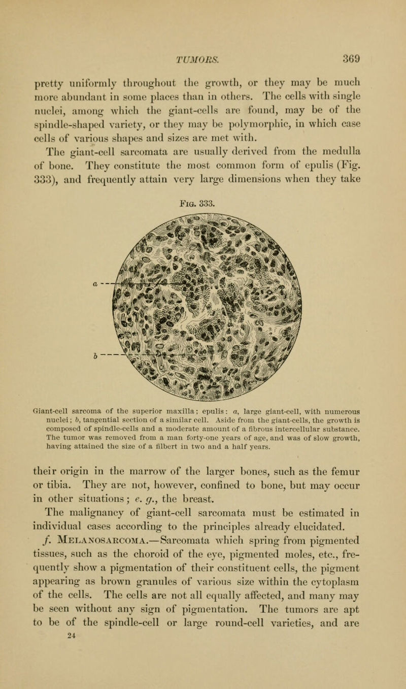 pretty nnifornily tlin)u<j;;h<)ut the jjrowtli, or they may be much more abundant in some places than in others. Tlie cells with single nuclei, among which the giant-cells are found, may be of the spindle-shaped variety, or they may be polymorphic, in which case cells of various shapes and sizes are met with. The giant-cell sarcomata are usually derived from the medulla of bone. They constitute the most common form of epulis (Fig. 333), and frequently attain very large dimensions when they take Fig. 333. b ' Giant-cell sarcoma of the superior maxilla; epulis: a, large giant-cell, with numerous nuclei; b, tangential section of a similar cell. Aside from the giant-cells, the growth is composed of spindle-cells and a moderate amount of a fibrous intercellular substance. The tumor was removed from a man forty-one years of age, and was of slow growth, having attained the size of a filbert in two and a half years. their origin in the marrow of the larger bones, such as the femur or tibia. They are not, however, confined to bone, but may occur in other situations ; e. g., the breast. The malignancy of giant-cell sarcomata must be estimated in individual cases according to the principles already elucidated. /. Mp:lanosarcoma.—Sarcomata which spring from pigmented tissues, such as the choroid of the eye, pigmented moles, etc., fre- cpiently show a pigmentation of their constituent cells, the pigment appearing as brown granules of various size within the cytoplasm of the cells. The cells are not all equally affected, and many may be seen without any sign of pigmentation. The tumors are apt to be of the spindle-cell or large round-cell varieties, and are 24