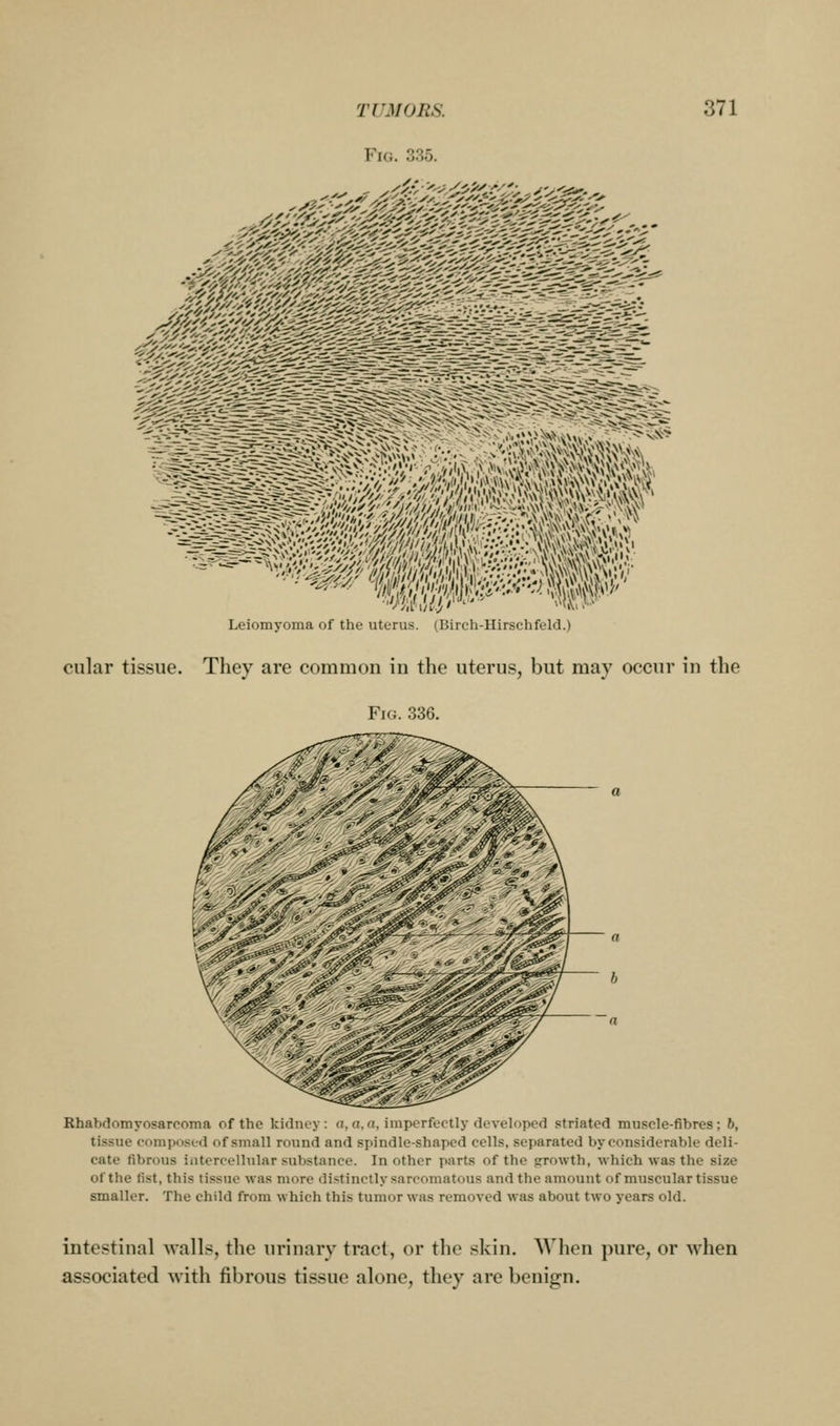 Fig. 335. Leiomyoma of the uterus. (Bircli-Hirschfeld.) oiilar tissue. They are common in the uterus, but may occur in the Fig. 336. Rhabdomyosarcoma of the kidney: a, o, a, imperfectly developed striated muscle-fibres; 6, tissue composed of small round and spindle-shaped cells, separated by considerable deli- cate fibrous intercellular substance. In other parts of the growth, which was the size of the fist, this tissue was more di.«tinctly sarcomatous and the amount of muscular tissue smaller. The child from which this tumor was removed was about two years old. intestinal walls, the urinary tract, or the skin. When pure, or when associated with fibrous tissue alone, they are benign.