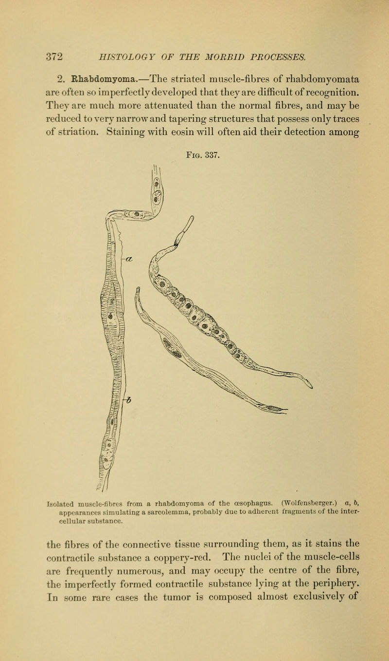 2. Rhabdomyoma.—The striated muscle-fibres of rhabdomyomata are often so imperfectly developed that they are difficult of recognition. They are much more attenuated than the normal fibres, and may be reduced to very narrow and tapering structures that possess only traces of striation. Staining with eosin will often aid their detection among Fig. 337. Isolated muscle-fibres from a rhabdomyoma of the oesophagus. (Wolfensberger.) a, b, appearances simulating a sarcolemma, probably due to adherent fragments of the inter- cellular substance. the fibres of the connective tissue surrounding them, as it stains the contractile substance a coppery-red. The nuclei of the muscle-cells are frequently numerous, and may occupy the centre of the fibre, the imperfectly formed contractile substance lying at the periphery. In some rare cases the tumor is composed almost exclusively of