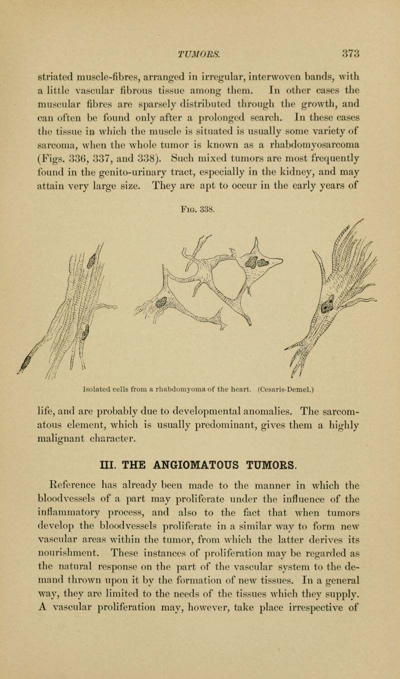 striated muscle-fibres, arranged in irregular, interwoven bands, with a little vascular fibrous tissue among them. In other cases the muscular fibres are sparsely distributed through the growth, and can often be found only after a prolonged search. In these cases the tissue iu wliich the muscle is situated is usually some variety of sarcoma, when the whole tumor is known as a rhabdomyosarcoma (Figs. e336, 337, and 338). Such mixed tumors are most frequently found in the genito-urinary tract, especially in the kidney, and may attain very large size. They are apt to occur in the early years of Fig. 338. Isolated ceUs from a rhabdoniyoma of the heart. (Ccsaris-Demel.) life, and are probably due to developmental anomalies. The sarcom- atous element, which is usually predominant, gives them a highly malignant character. m. THE ANGIOMATOUS TUMORS. Reference has already been made to the manner in which the bloodvessels of a part may proliferate under the influence of the inflammatory process, and also to the fiict that when tumors develop the bloodvessels proliferate in a similar way to form new vascular areas within the tumor, from which the latter derives its nourishment. These instances of proliferation may be regarded as the natural respon.sc on the part of the vascular system to the de- mand thrown upon it by the formation of new tissues. In a general way, they are limited to the needs of the tissues which they supply. A vascular ]>roliferation may, however, take place irrespective of