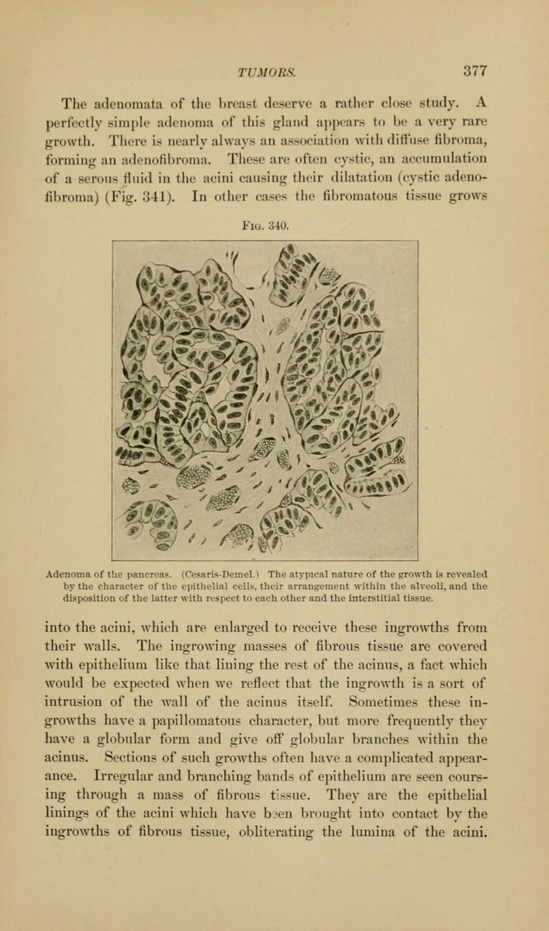 The adenomata of tlie breast deserve a rather close study. A perfectly simple adenoma of this gland appears to be a very rare growth. Tiu-re is nearly always an association with dilfnse fibroma, forming an adenofibroma. These are often cystic, an accumulation of a serous fluid in the acini causing their dilatation (cystic adeno- fibroma) (Fig. 341). In other cases the fibromatous tissue grows Fig. 340. Adenoma of the pancreas. (Cesaris-Demel.) The atypical nature of the growth is revealed by the character of the epithelial cells, their arrangement within the alveoli, and the disposition of the latter with respect to each other and the interstitial tissue. into the acini, which are enlarged to receive these ingrowths from their walls. The ingrowing masses of fibrous tissue are covered with epithelium like that lining the rest of the acinus, a fact which would be expected when we reflect that the ingrowth is a sort of intrusion of the wall of the acinus it.self. Sometimes these in- growths have a papillomatous character, but more frequently they have a globular form and give off globular branches within the acinus. Sections of such growths often have a complicated appear- ance. Irregular and branching bands of epithelium are seen cours- ing through a mass of fibrous tissue. They are the epithelial linings of the acini which have b.^en brought into contact by the ingrowths of fibrous tissue, obliterating the lumina of the acini.