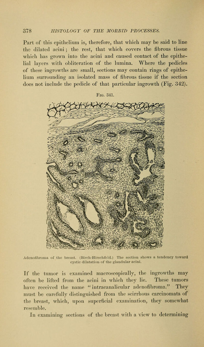 Part of this epithelium is, therefore, that which may be said to line the dilated acini; the rest, that which covers the fibrous tissue which has groM'n into the acini and caused contact of the epithe- lial layers with obliteration of the lumina. Where the pedicles of these ingrowths are small, sections may contain rings of epithe- lium surroundino^ an isolated mass of fibrous tissue if the section does not include the pedicle of that particular ingrowth (Fig. 342). Fig. 341. i Adenofibroma of the breast. (Birch-Hirschfeld.) The section shows a tendency toward cystic dilatation of the glandular acini. If the tumor is examined macroscopically, the ingrowths may often be lifted from the acini in which they lie. These tumors have received the name  intracanalicular adenofibroma. They must be carefully distinguished from the scirrhous carcinomata of the breast, which, upon superficial examination, they somewhat resemble. In examining sections of the brca.'^t witli a view to determining