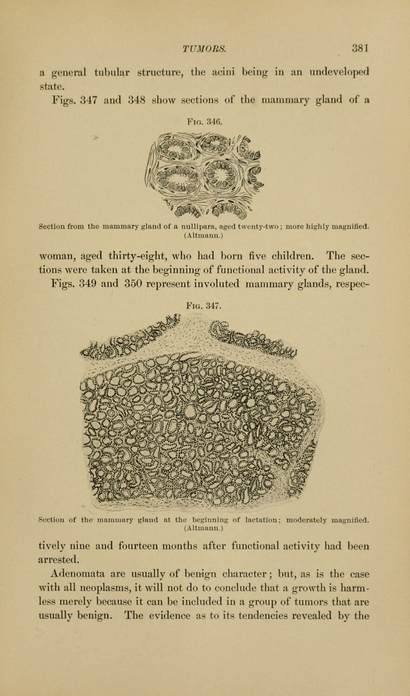 a general tubular structure, the acini Ijcing in an undeveloped state. Figs. 347 and 348 show sections of the nuunniary gland of a Section from the mammary gland of a nullipara, aged twenty-two ; more highly magnified. (Altmann.) woman, aged thirty-eight, who had horn five children. The sec- tions were taken at the beginning of functional activity of the gland. Figs. 349 and 350 represent involuted mammary glands, respec- FiG. 347. Section of the mammary gland at the beginning of lactation; moderately magnified. (.\ltmann.) tively nine and fourteen months after functional activity had been arrested. Adenomata are usually of benign character; but, as is the case with all neoplasms, it will not do to conclude that a growth is harm- less merely because it can be included in a group of tumors that are usually benign. The evidence as to its tendencies revealed by the